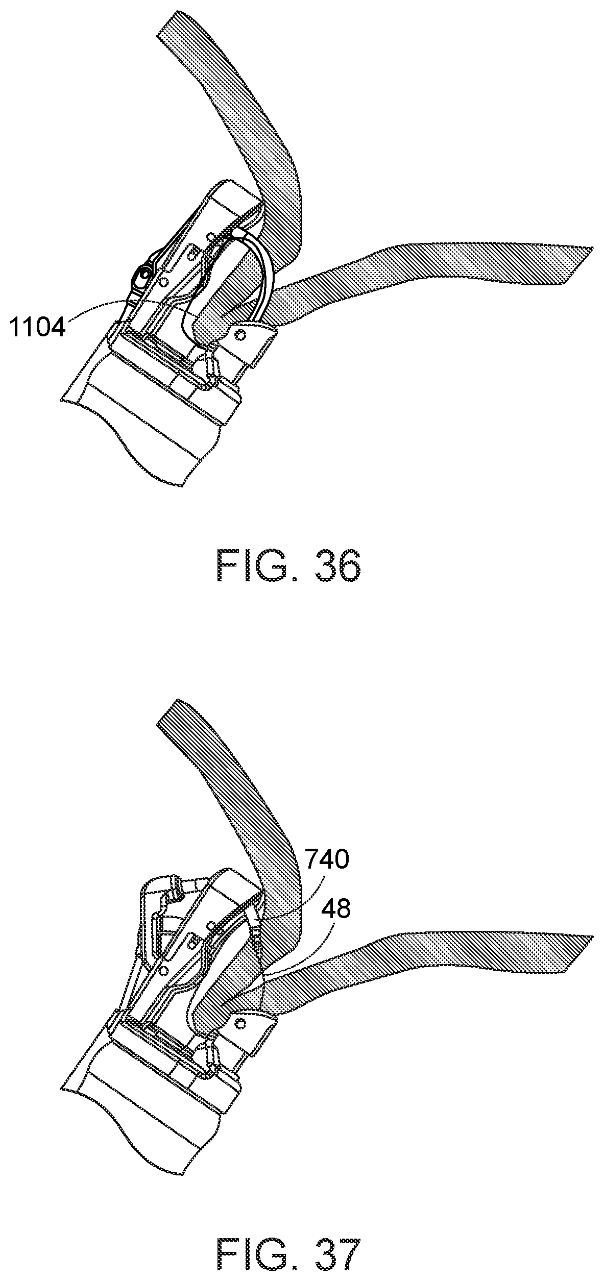 Patent US12310578 Figure 20 – Endoscopic suture loop anchors and methods