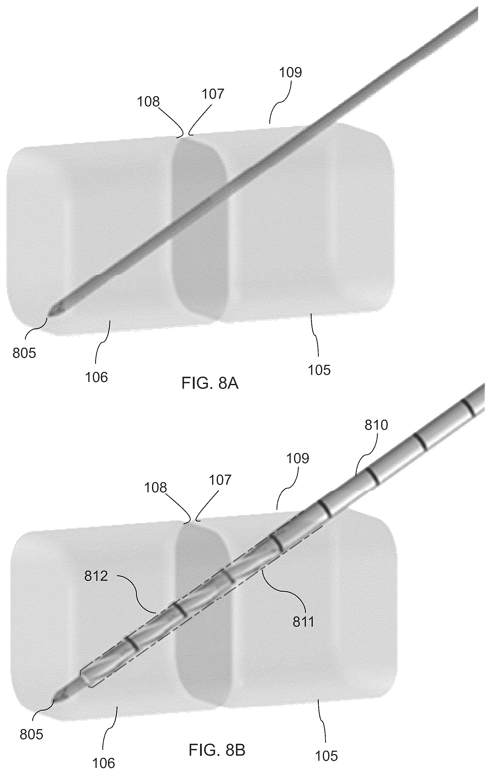 Patent US12310581 Figure 10 – Fixation assembly and method of use