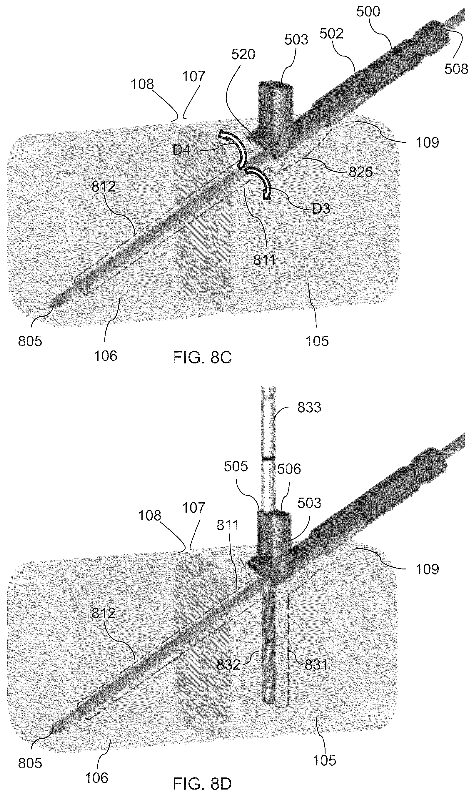 Patent US12310581 Figure 11 – Fixation assembly and method of use