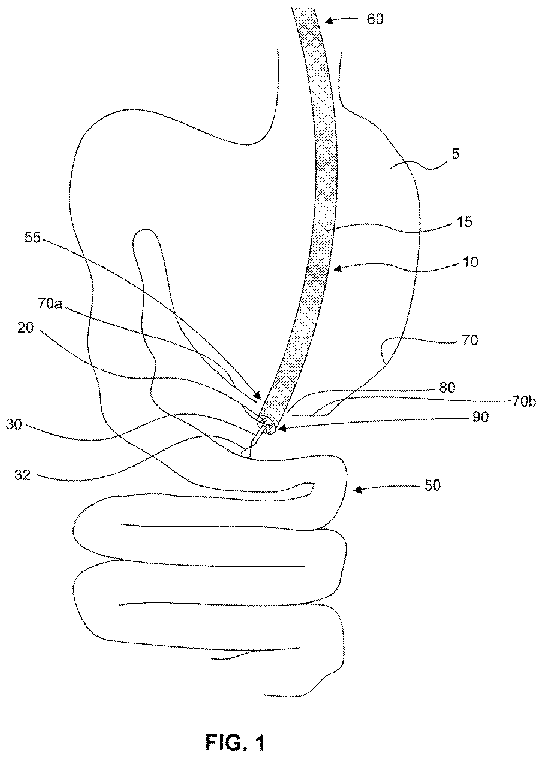 Patent US12310588 Figure 1 – Devices for approximating tissue and related methods of use