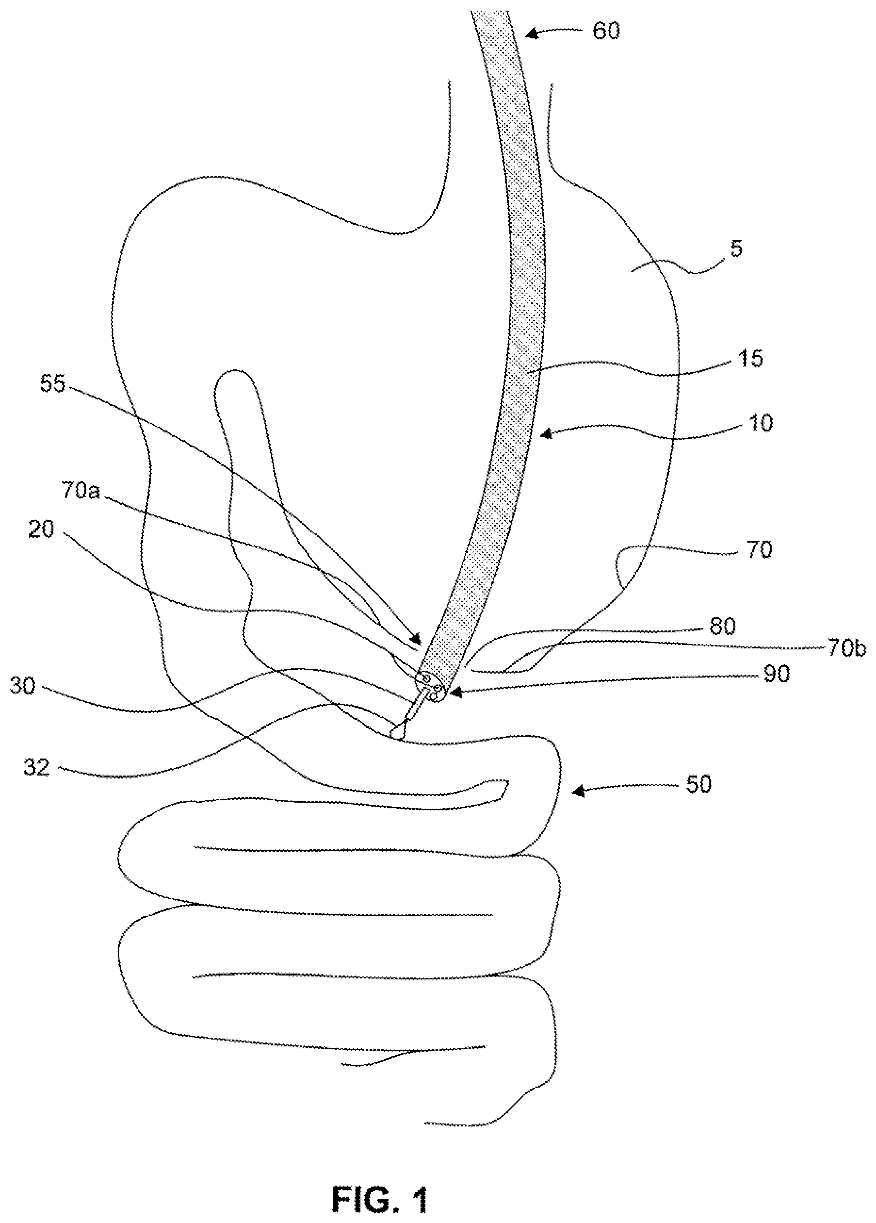 Patent US12310589 — Devices for approximating tissue and related methods of use — Figure 1