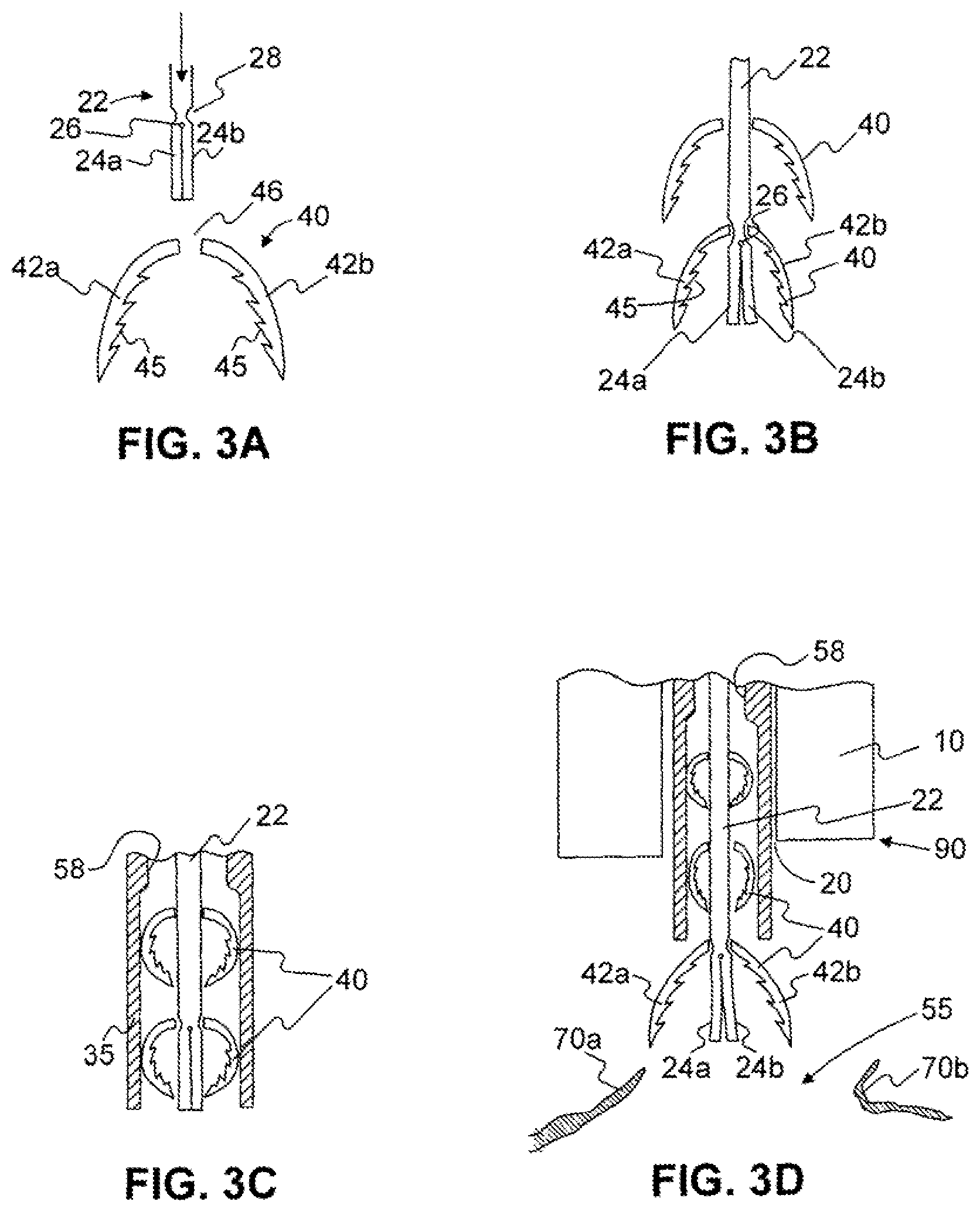 Patent US12310589 Figure 3 – Devices for approximating tissue and related methods of use