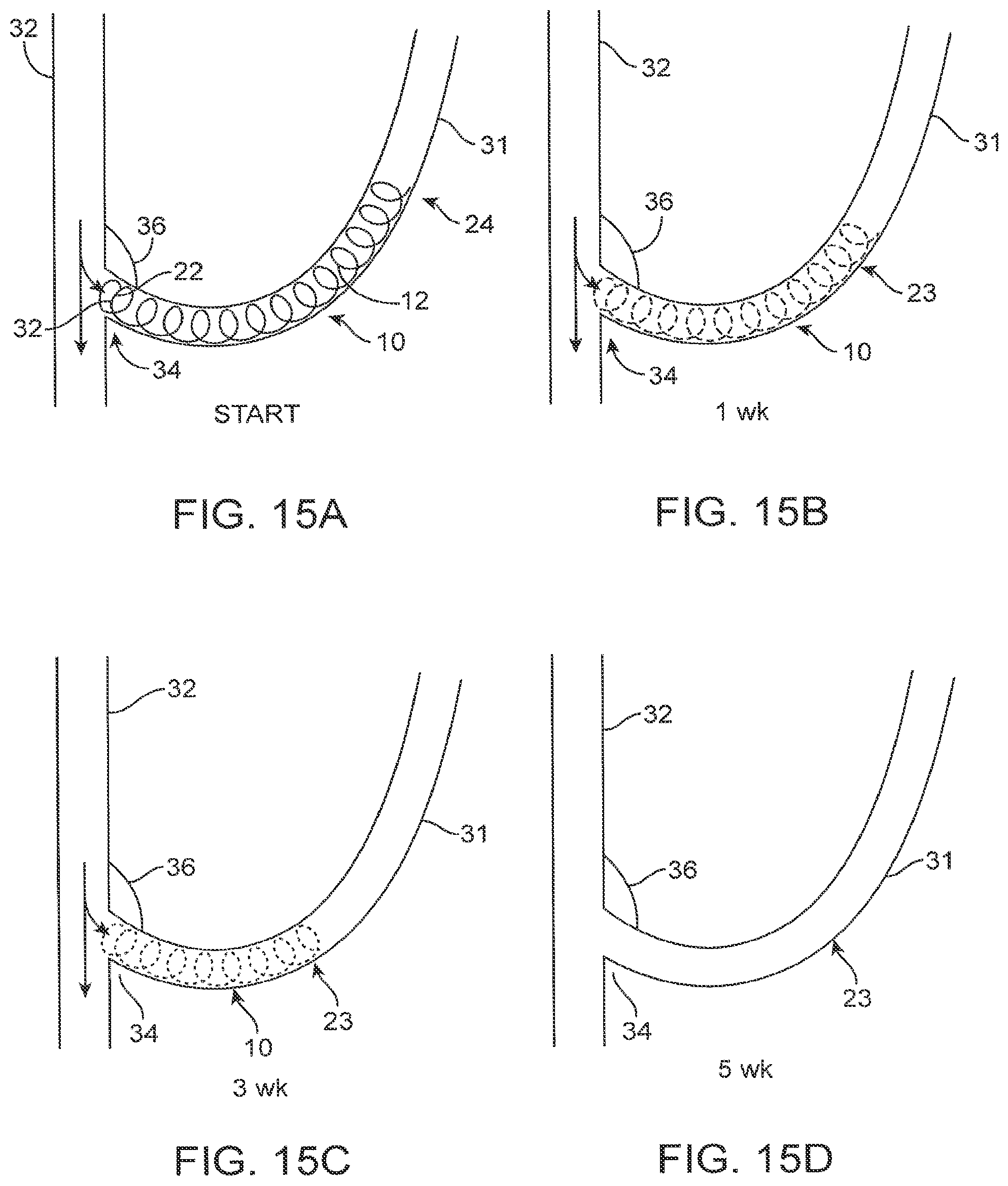 Patent US12310590 Figure 16 – Platform device and method of use to assist in anastomosis formation