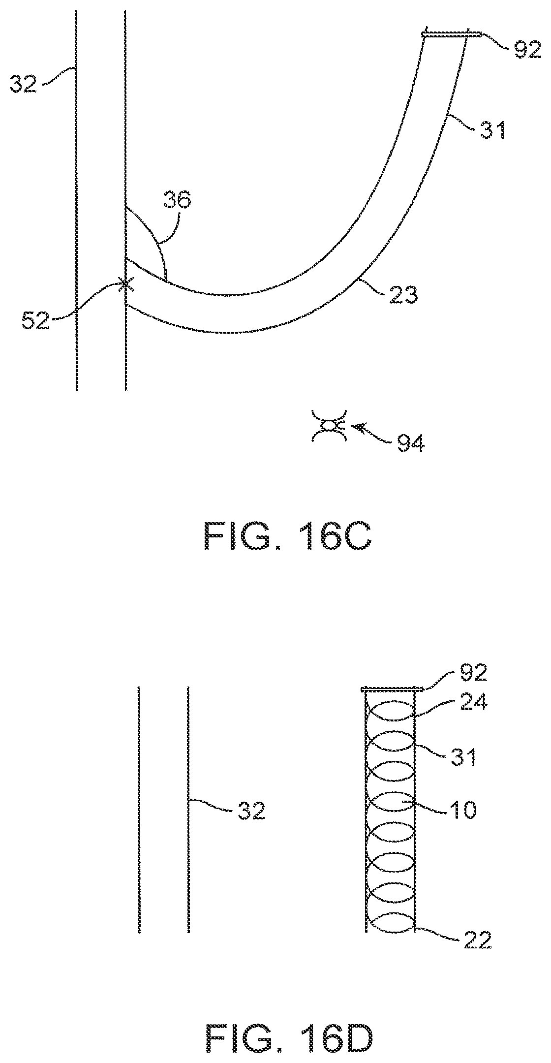 Patent US12310590 Figure 18 – Platform device and method of use to assist in anastomosis formation