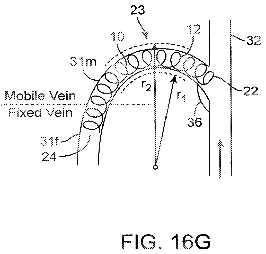 Patent US12310590 Figure 20 – Platform device and method of use to assist in anastomosis formation