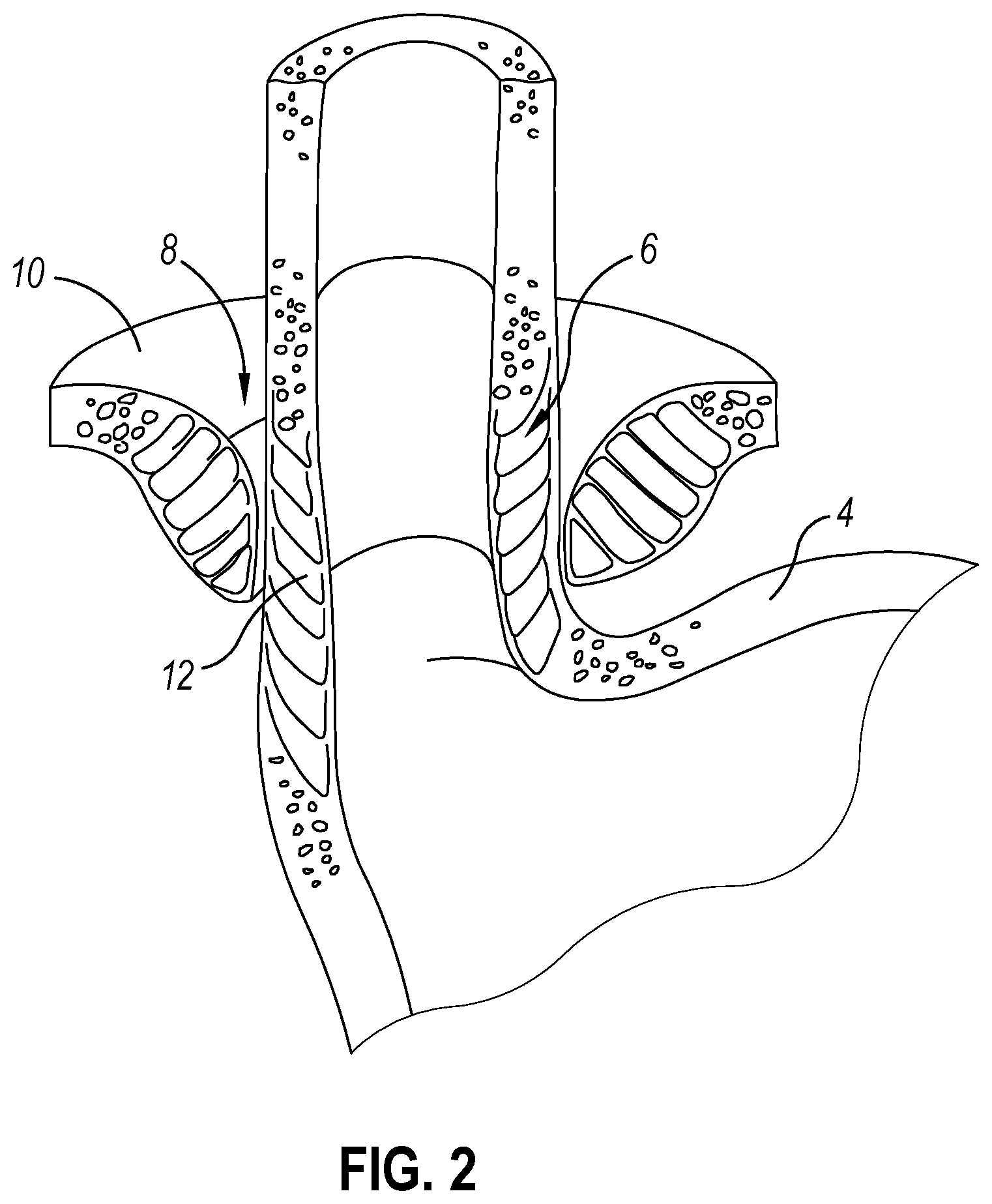 Patent US12310593 Figure 2 – Implantable sphincter device with bead orientation control based on bead interactive geometry
