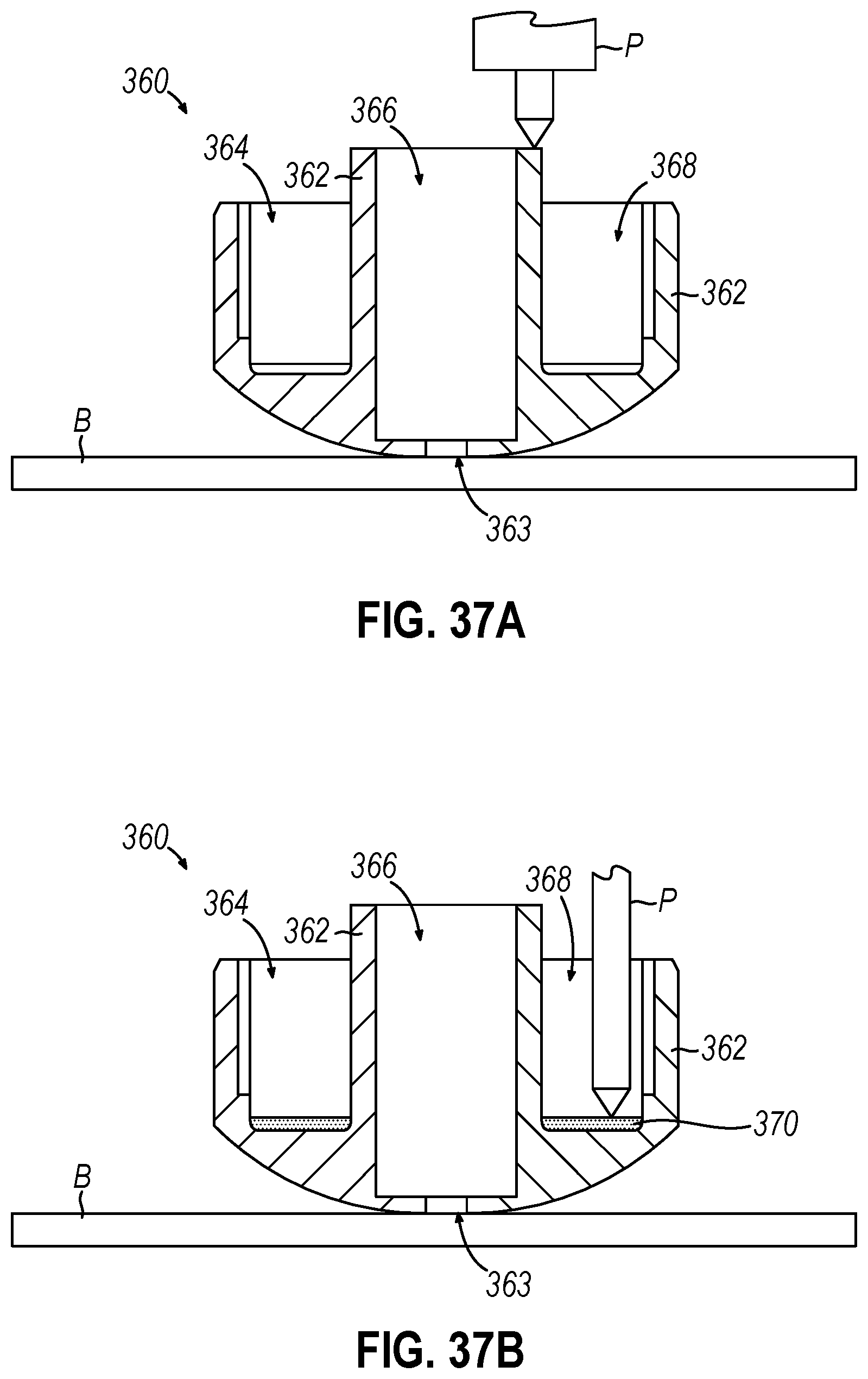 Patent US12310593 Figure 19 – Implantable sphincter device with bead orientation control based on bead interactive geometry