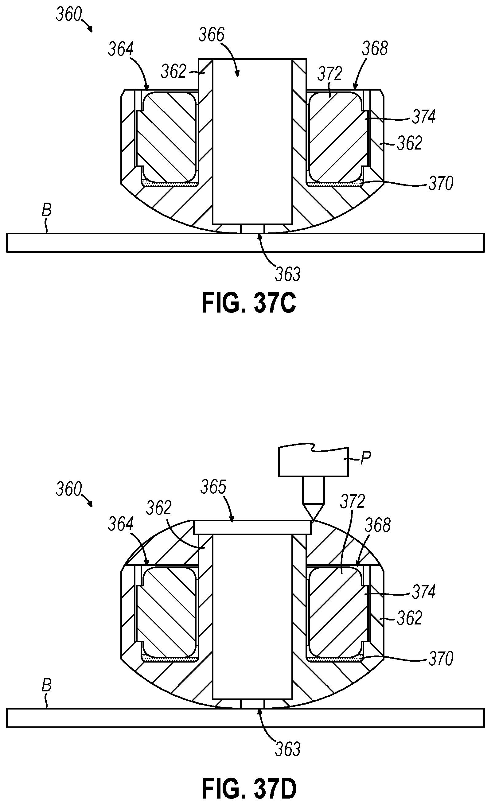 Patent US12310593 Figure 20 – Implantable sphincter device with bead orientation control based on bead interactive geometry