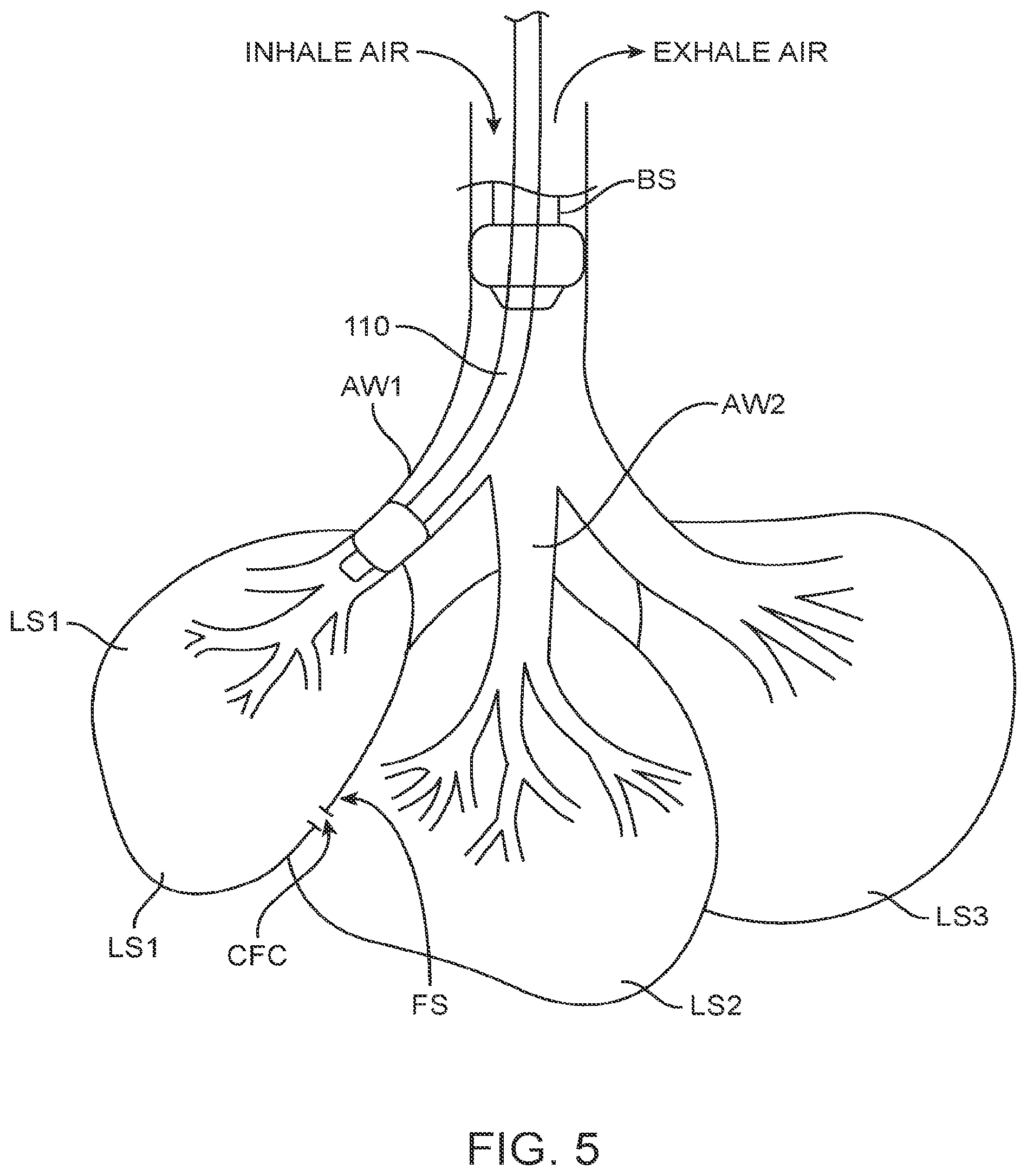 Patent US12310594 Figure 5 – Collateral flow channel sealant delivery methods and systems