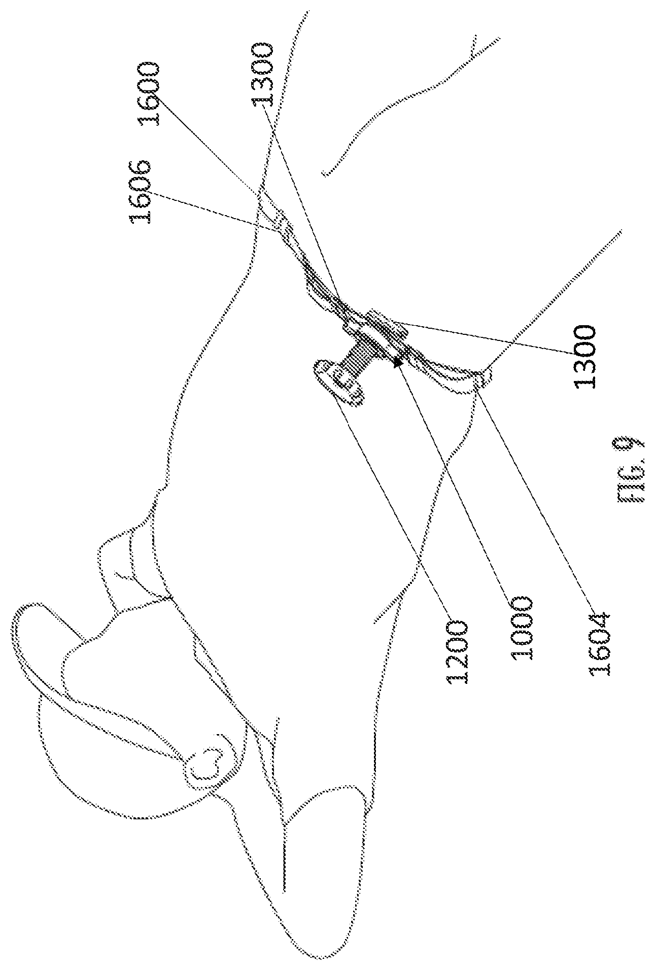 Patent US12310598 Figure 9 – Junctional tourniquet