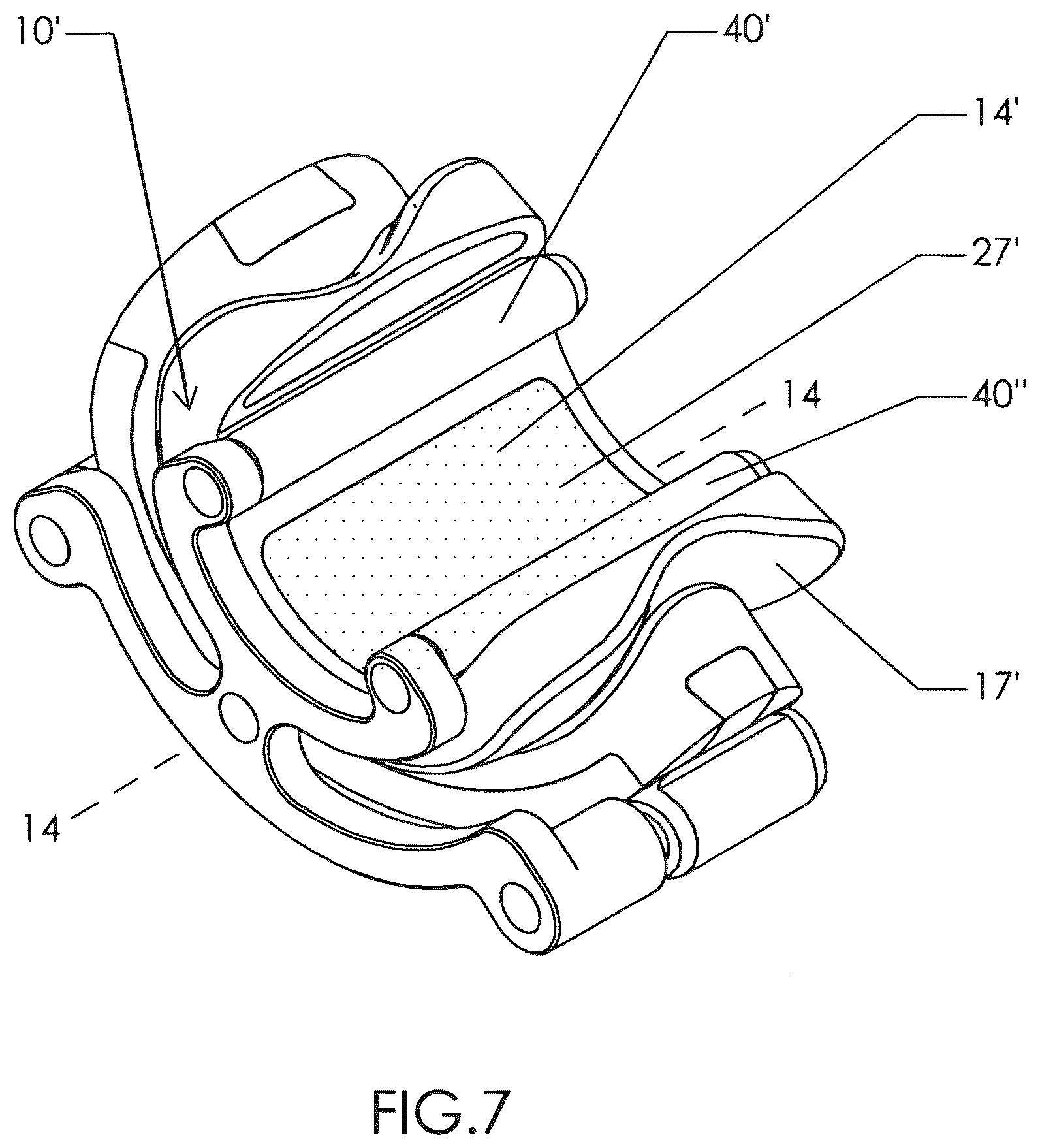 Patent US12310602 Figure 6 – Milling apparatus for implanting a joint prosthesis