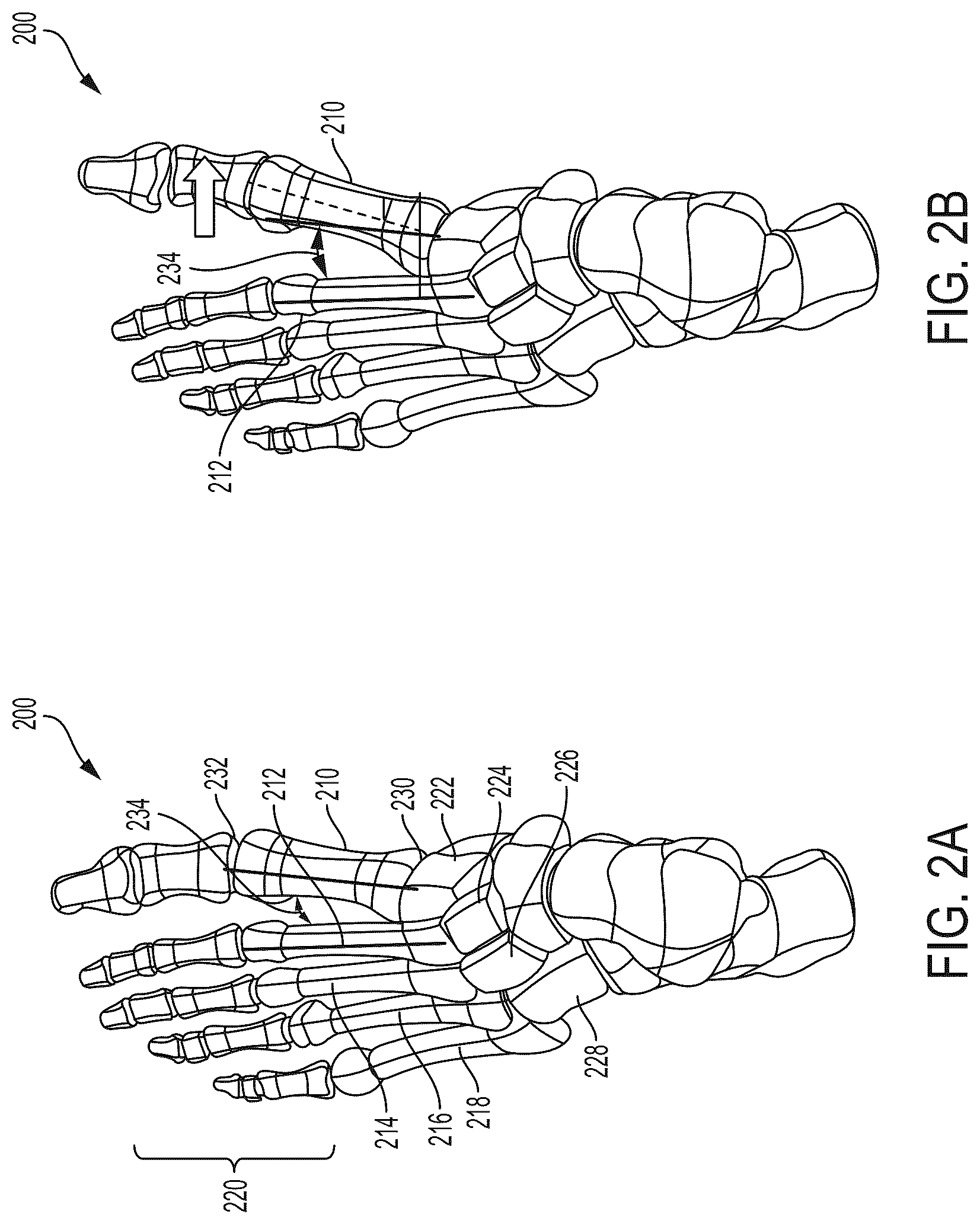 Patent US12310603 Figure 2 – System and technique for metatarsal realignment with reduced incision length