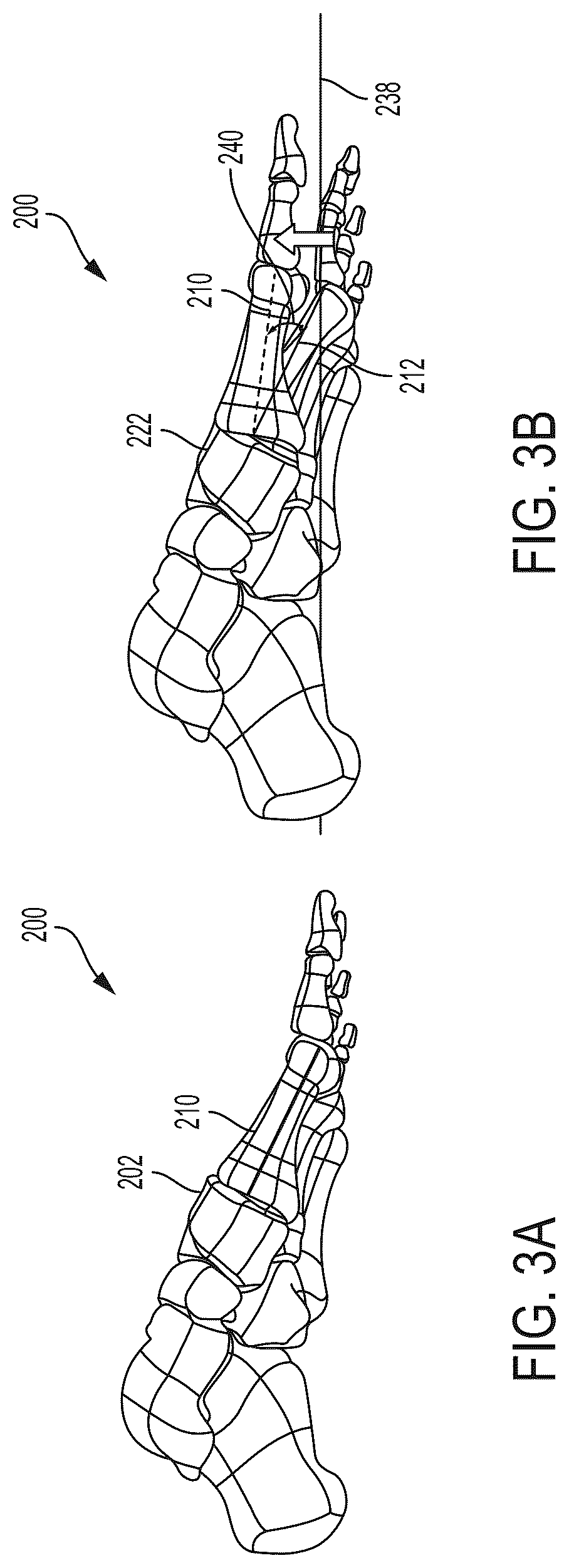 Patent US12310603 Figure 3 – System and technique for metatarsal realignment with reduced incision length