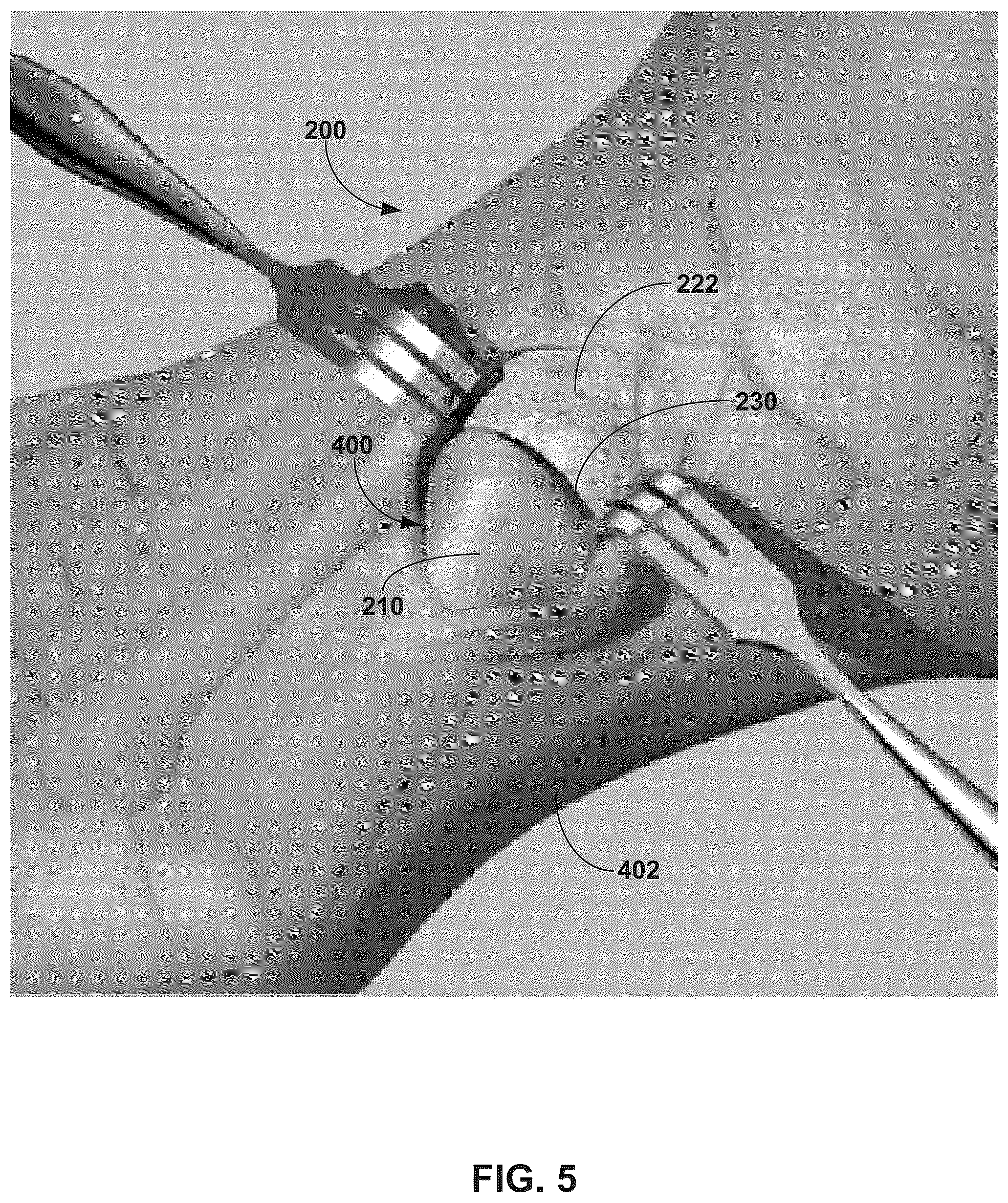 Patent US12310603 Figure 5 – System and technique for metatarsal realignment with reduced incision length