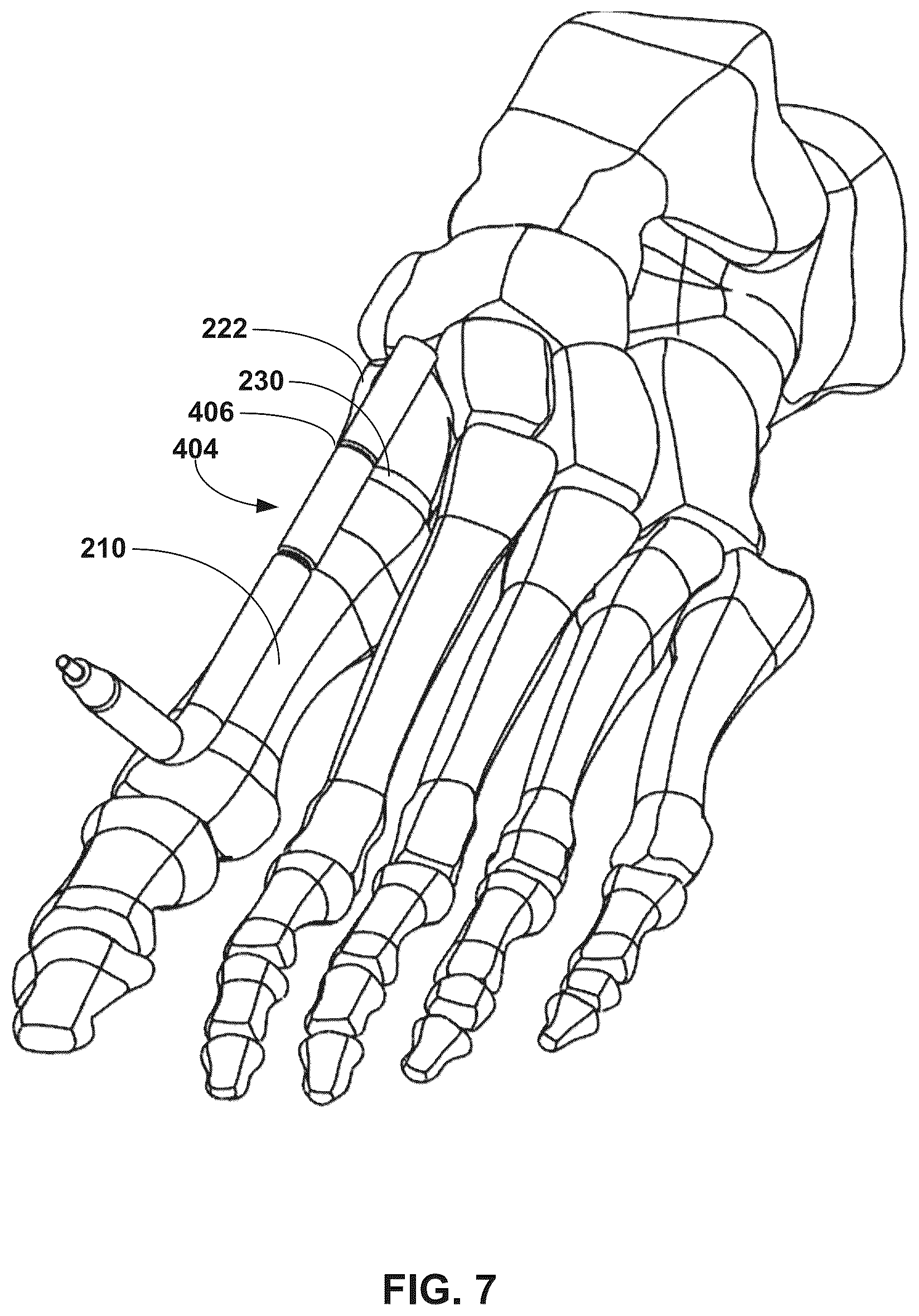 Patent US12310603 Figure 7 – System and technique for metatarsal realignment with reduced incision length