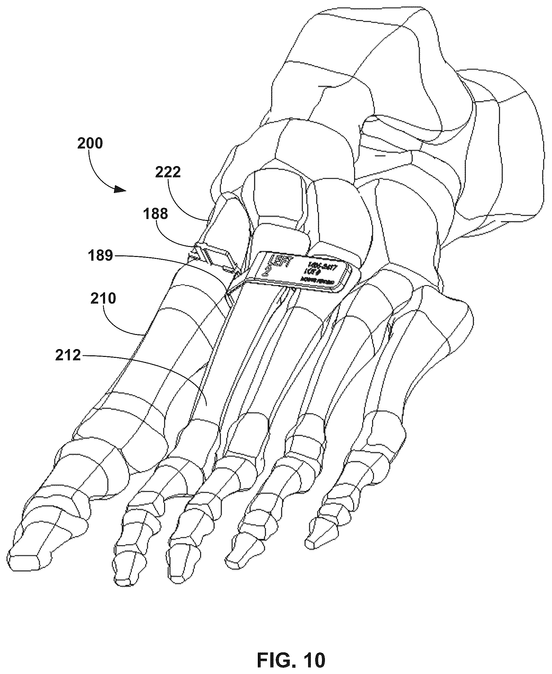Patent US12310603 Figure 10 – System and technique for metatarsal realignment with reduced incision length
