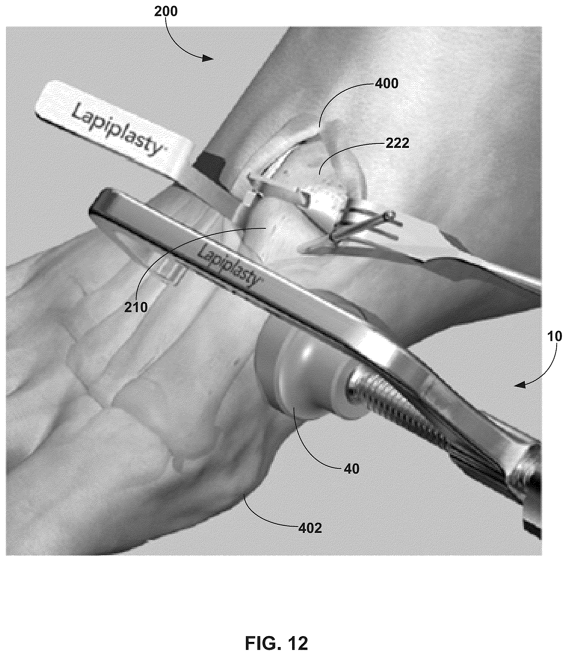 Patent US12310603 Figure 12 – System and technique for metatarsal realignment with reduced incision length