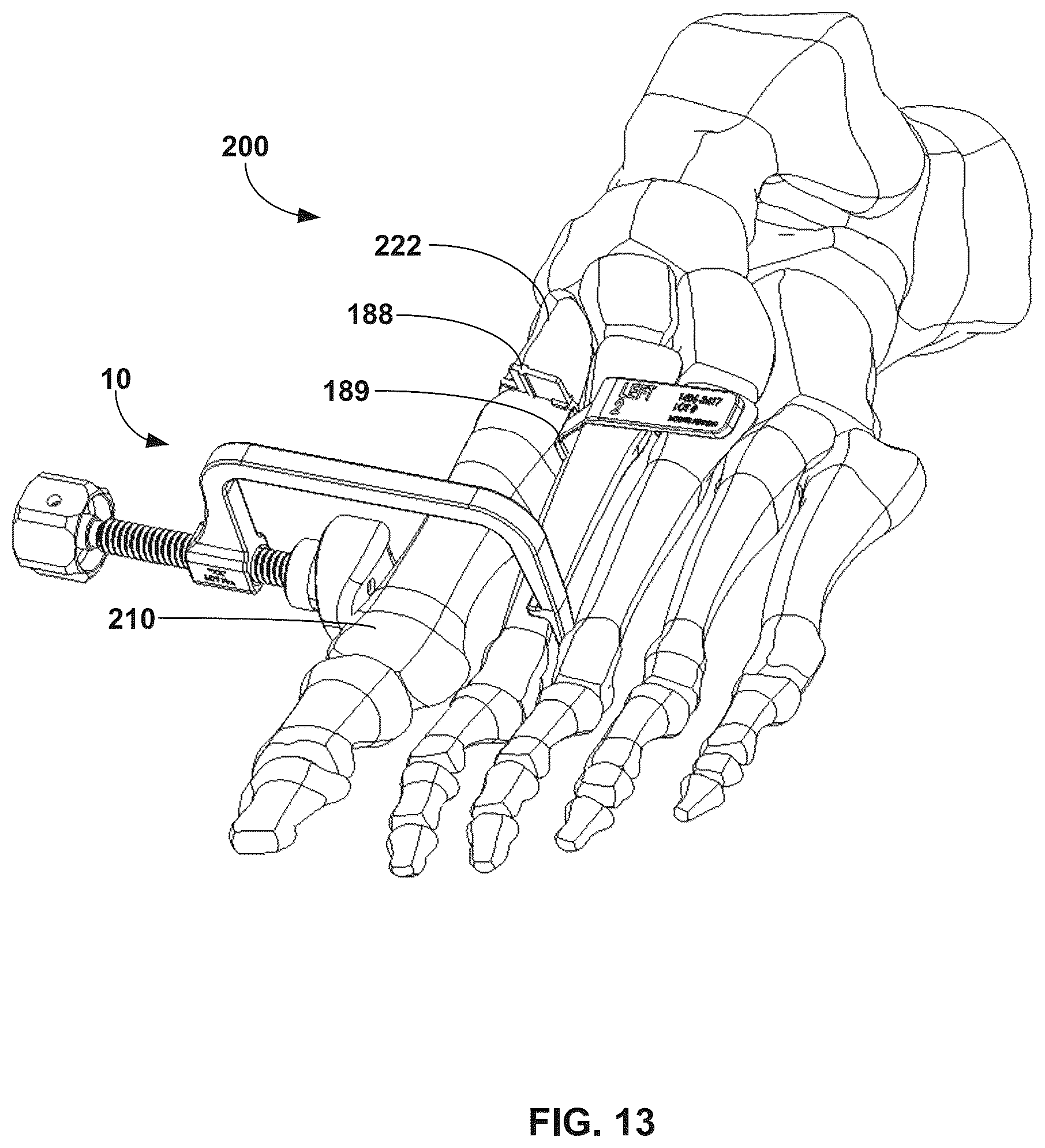 Patent US12310603 Figure 13 – System and technique for metatarsal realignment with reduced incision length
