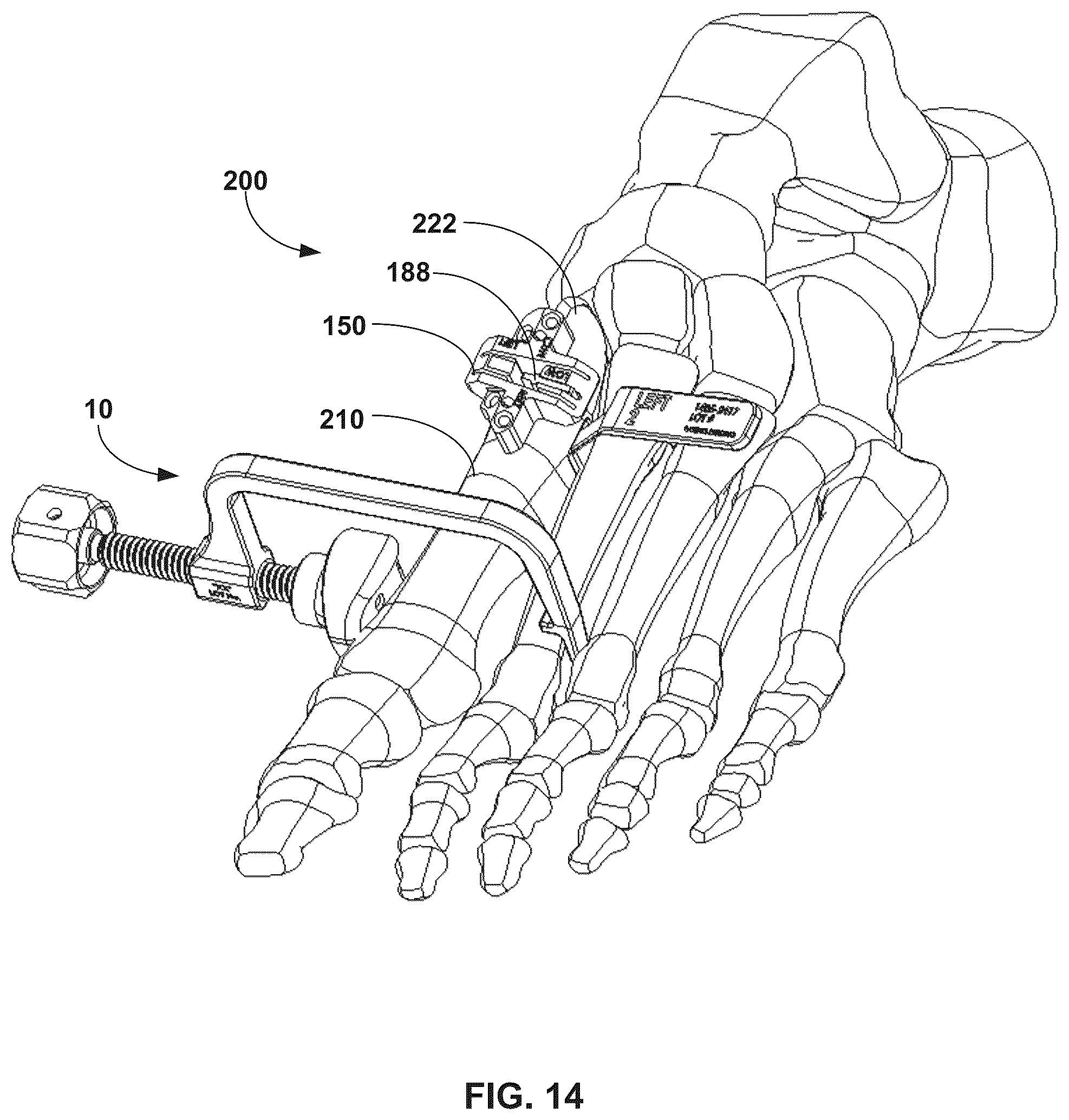 Patent US12310603 Figure 14 – System and technique for metatarsal realignment with reduced incision length