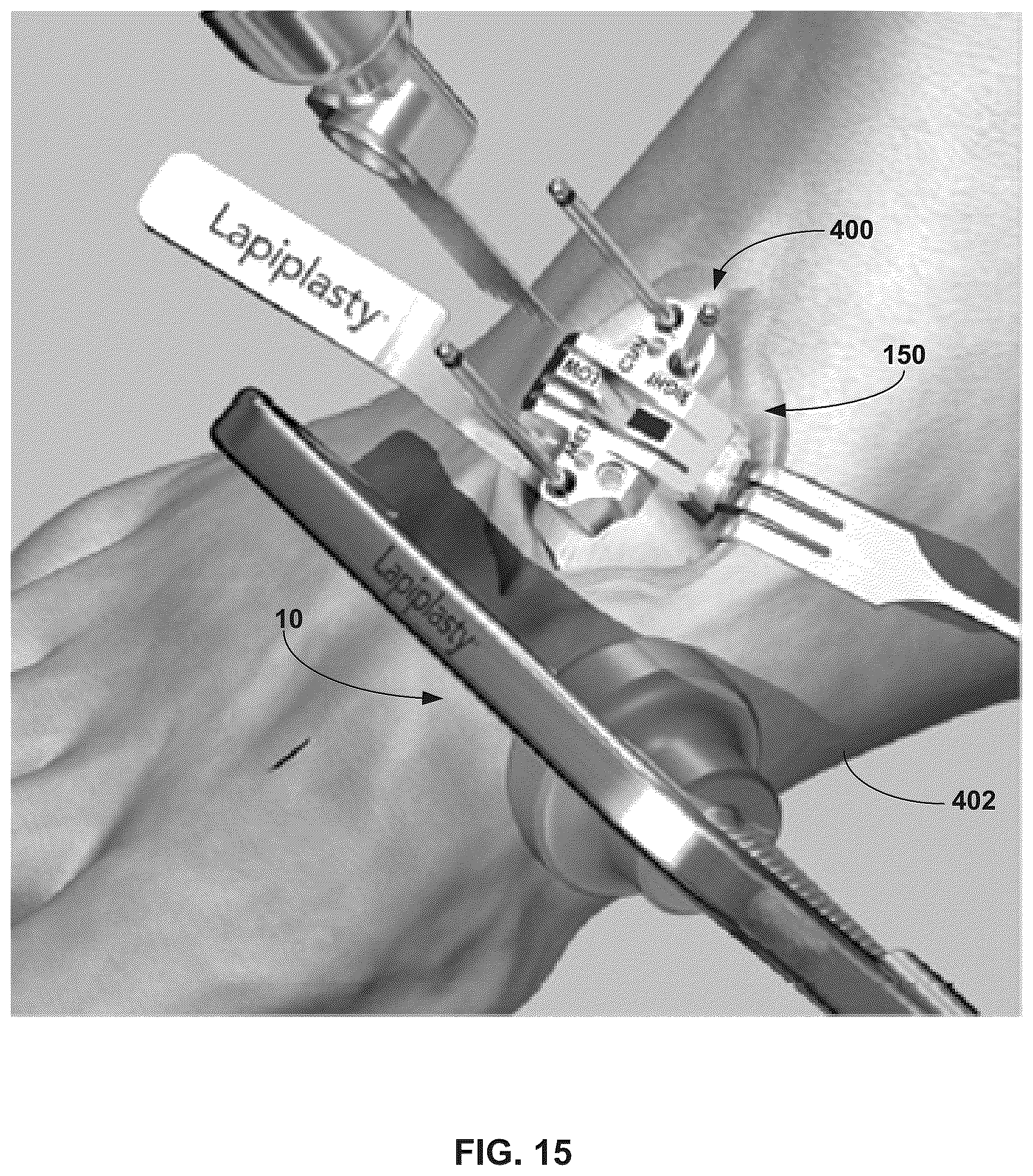 Patent US12310603 Figure 15 – System and technique for metatarsal realignment with reduced incision length