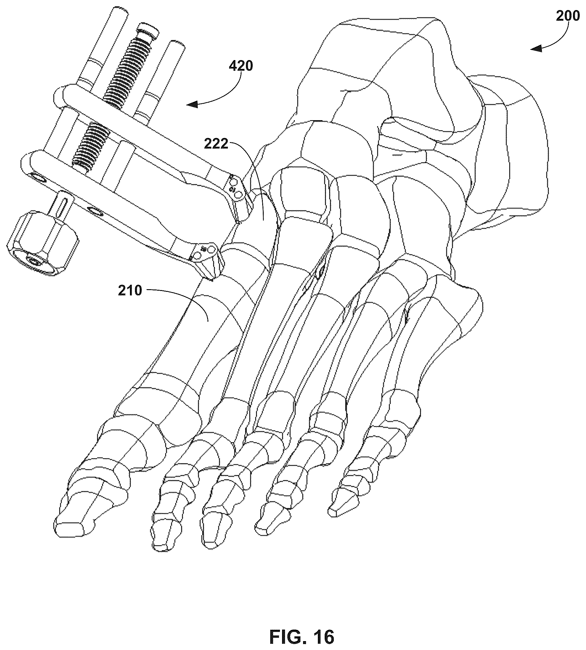 Patent US12310603 Figure 16 – System and technique for metatarsal realignment with reduced incision length