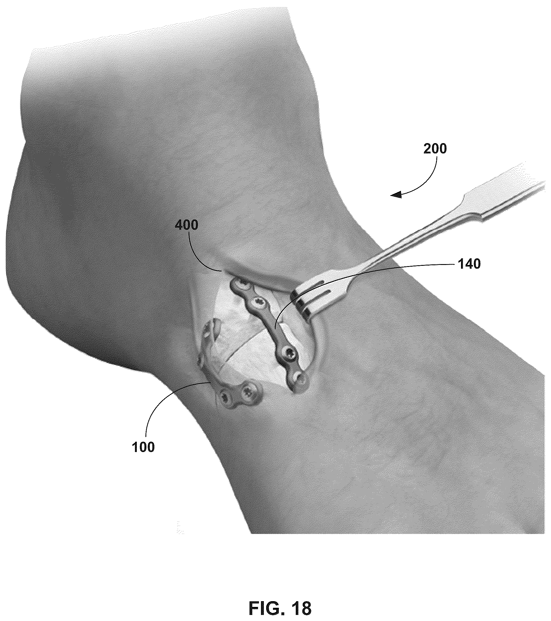 Patent US12310603 Figure 18 – System and technique for metatarsal realignment with reduced incision length