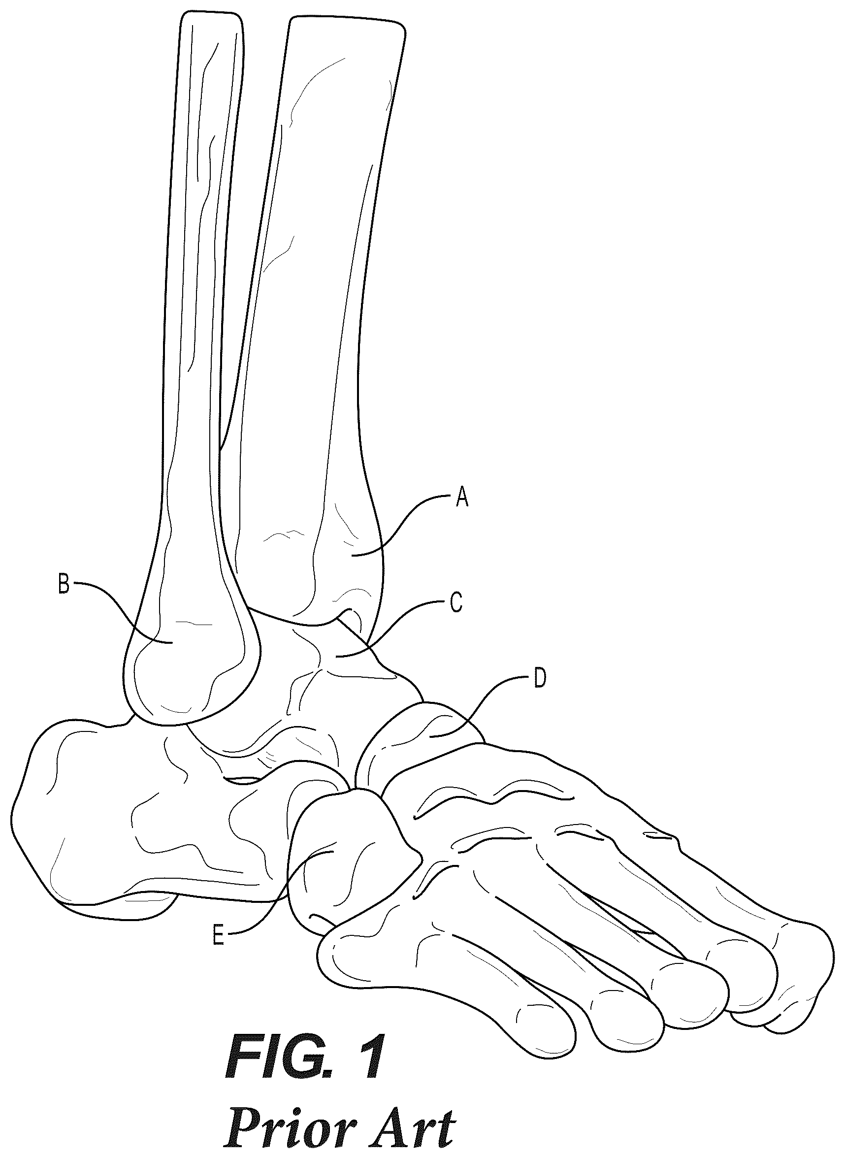 Patent US12310604 Figure 1 – Patient-specific template for total ankle replacement