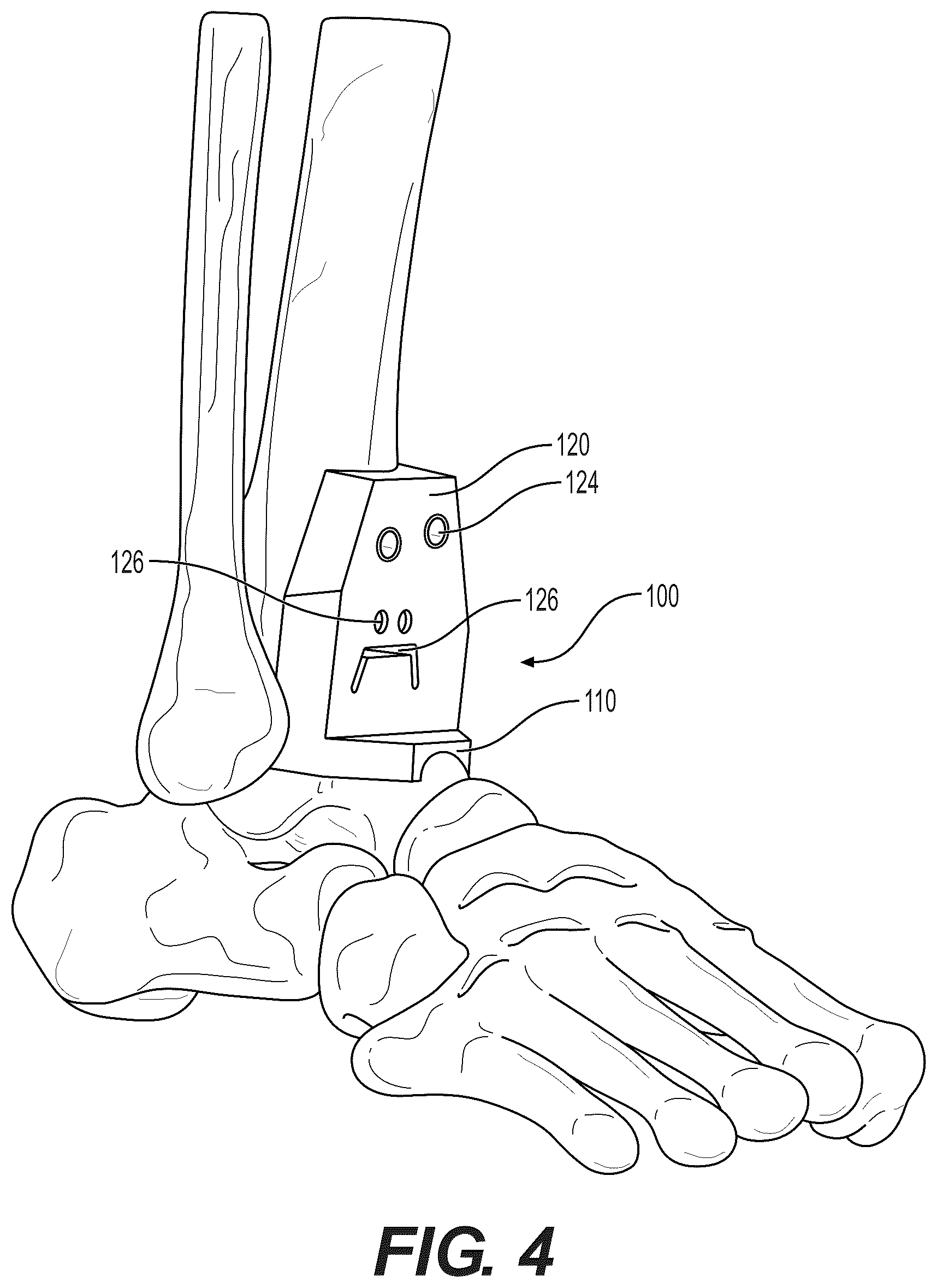 Patent US12310604 Figure 4 – Patient-specific template for total ankle replacement