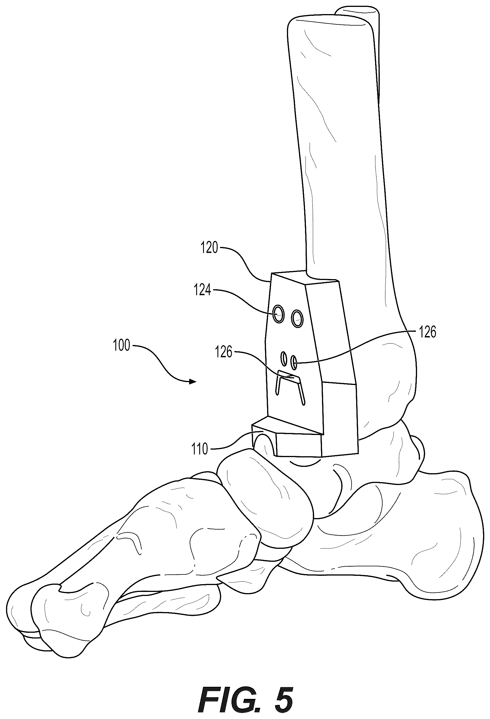 Patent US12310604 Figure 5 – Patient-specific template for total ankle replacement