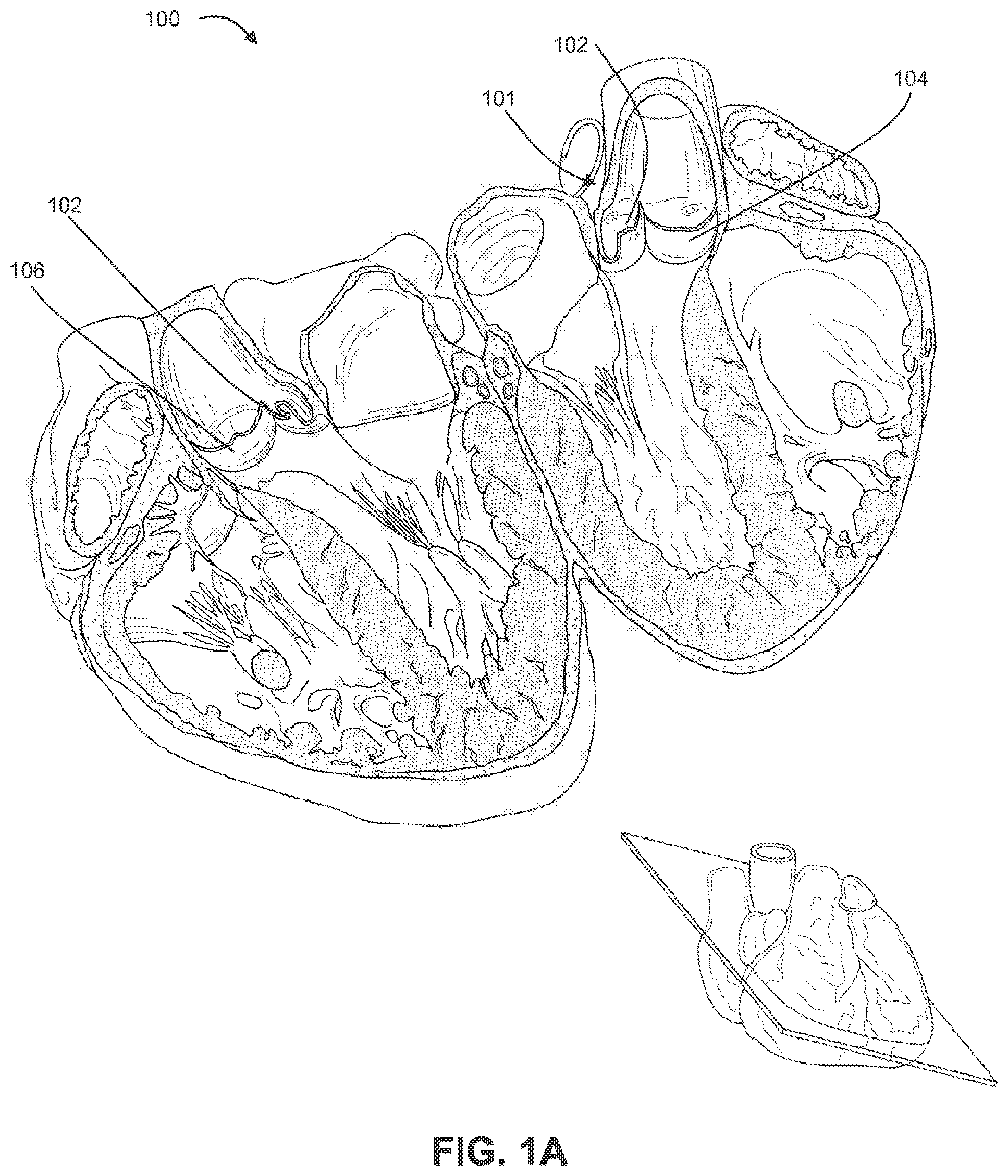 Patent US12310605 Figure 1 – Shock wave valvuloplasty with multiple balloons