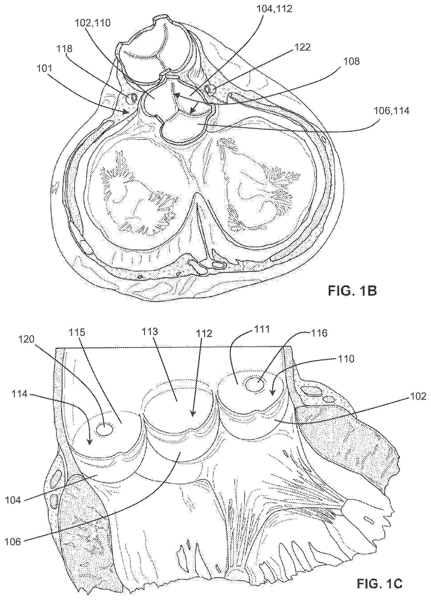 Patent US12310605 Figure 2 – Shock wave valvuloplasty with multiple balloons