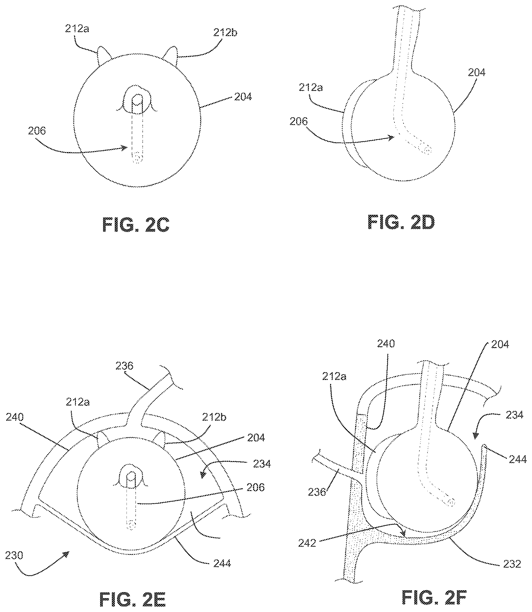Patent US12310605 Figure 5 – Shock wave valvuloplasty with multiple balloons