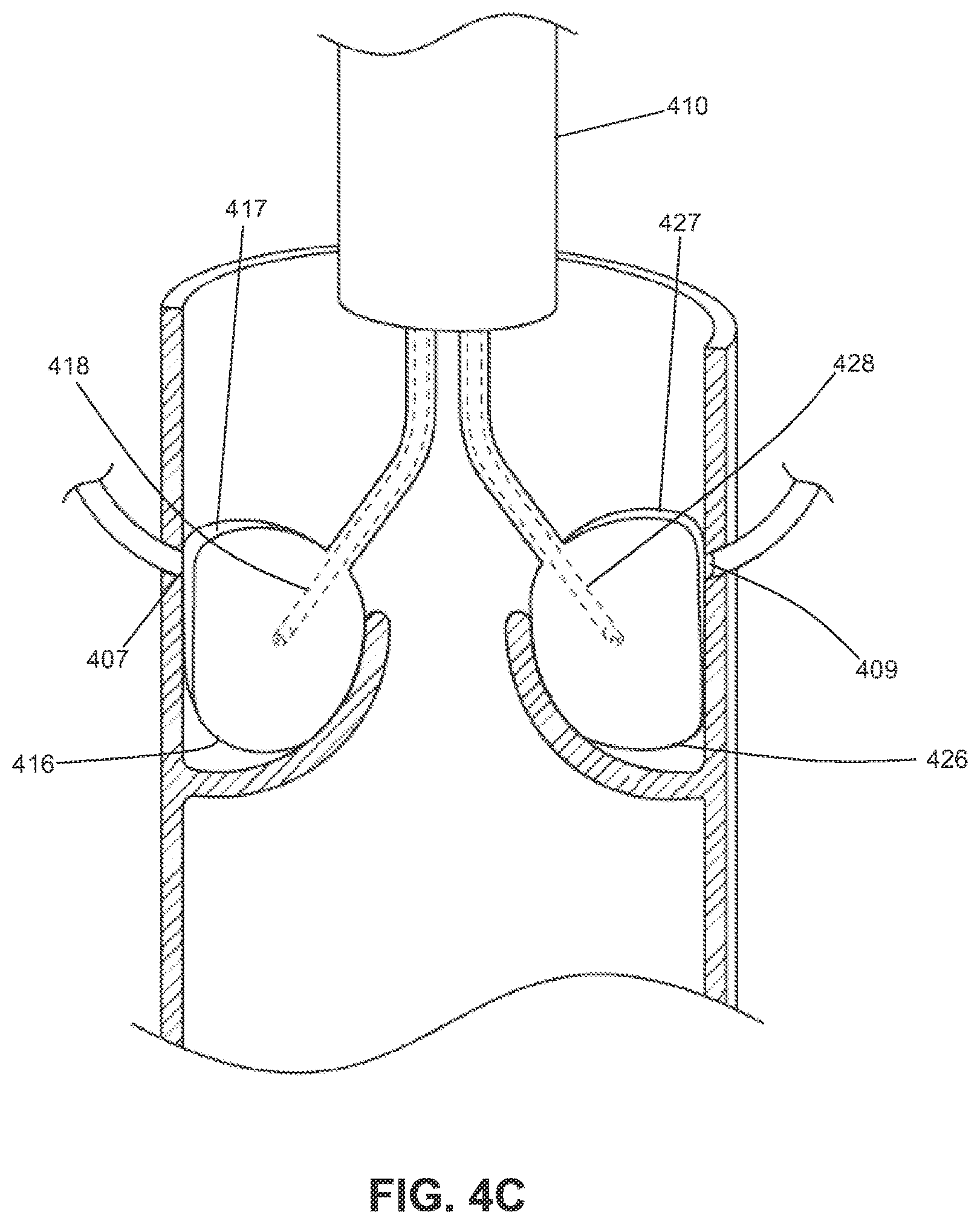 Patent US12310605 Figure 9 – Shock wave valvuloplasty with multiple balloons