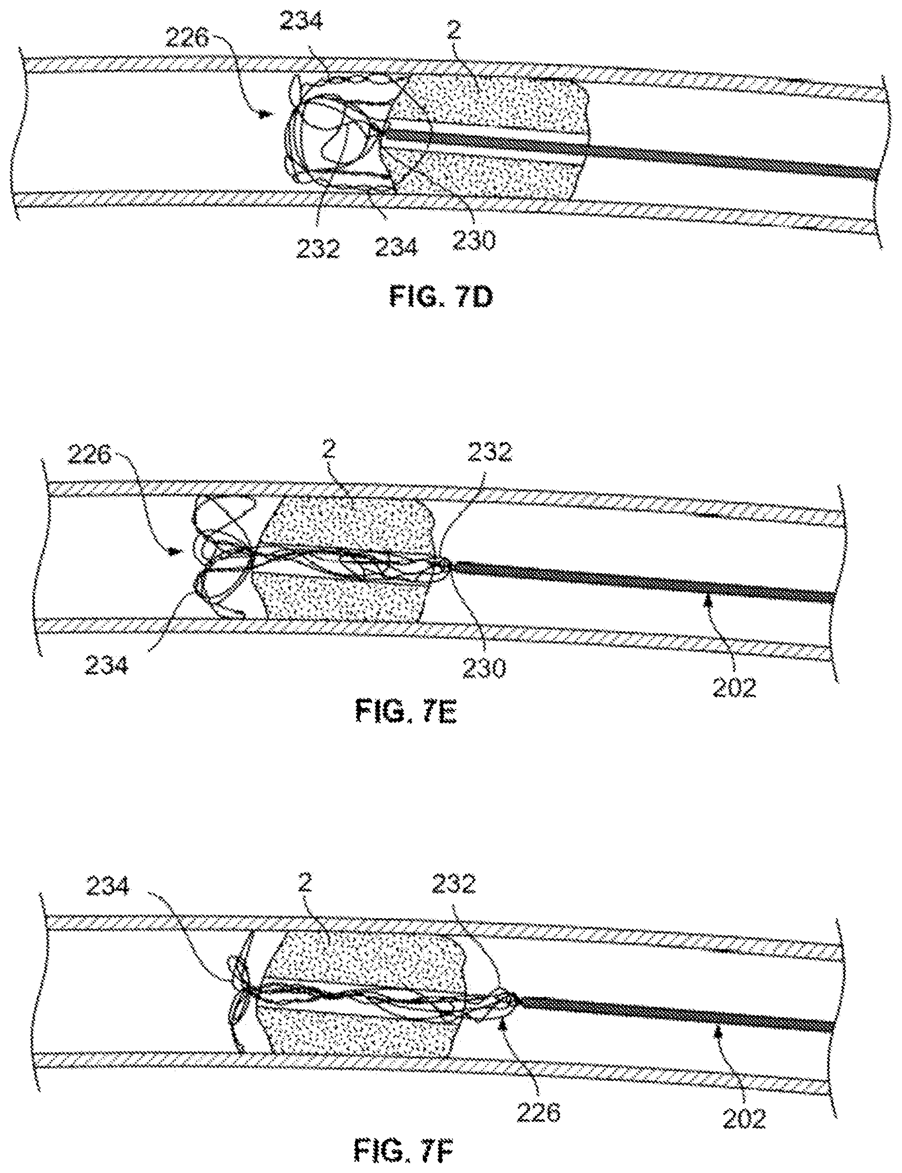 Patent US12310607 Figure 15 – Retrieval systems and methods for use thereof