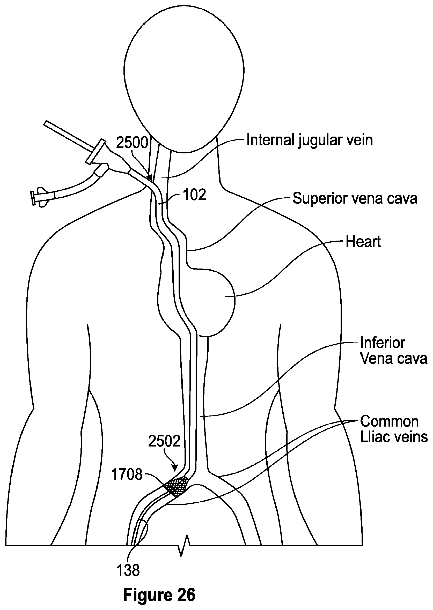 Patent US12310608 Figure 19 – Intravascular treatment of vascular occlusion and associated devices, systems, and methods