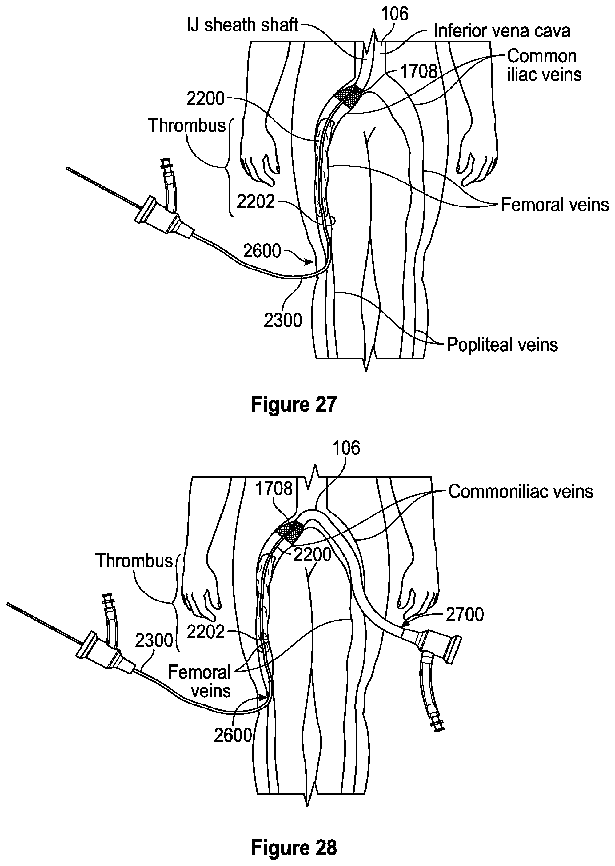 Patent US12310608 Figure 20 – Intravascular treatment of vascular occlusion and associated devices, systems, and methods