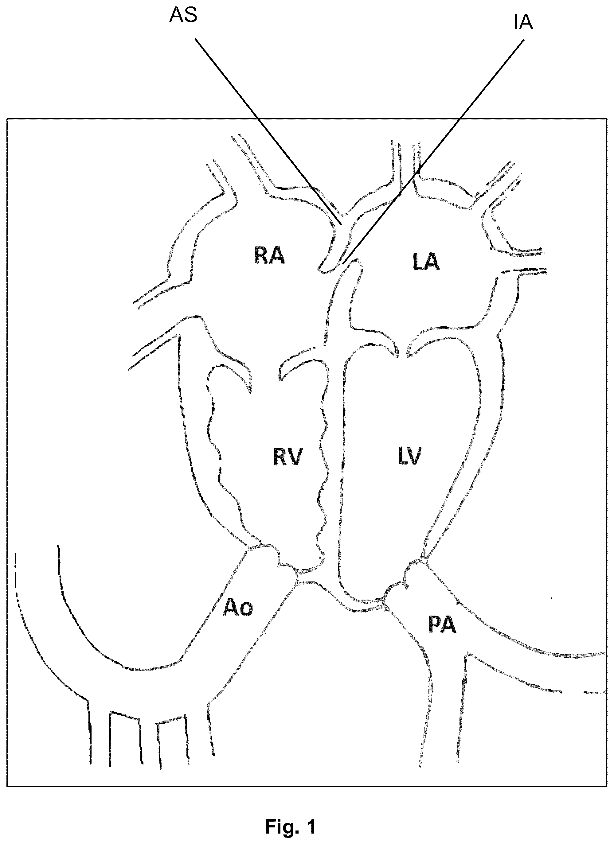 Patent US12310616 Figure 1 – Septostomy balloon catheter