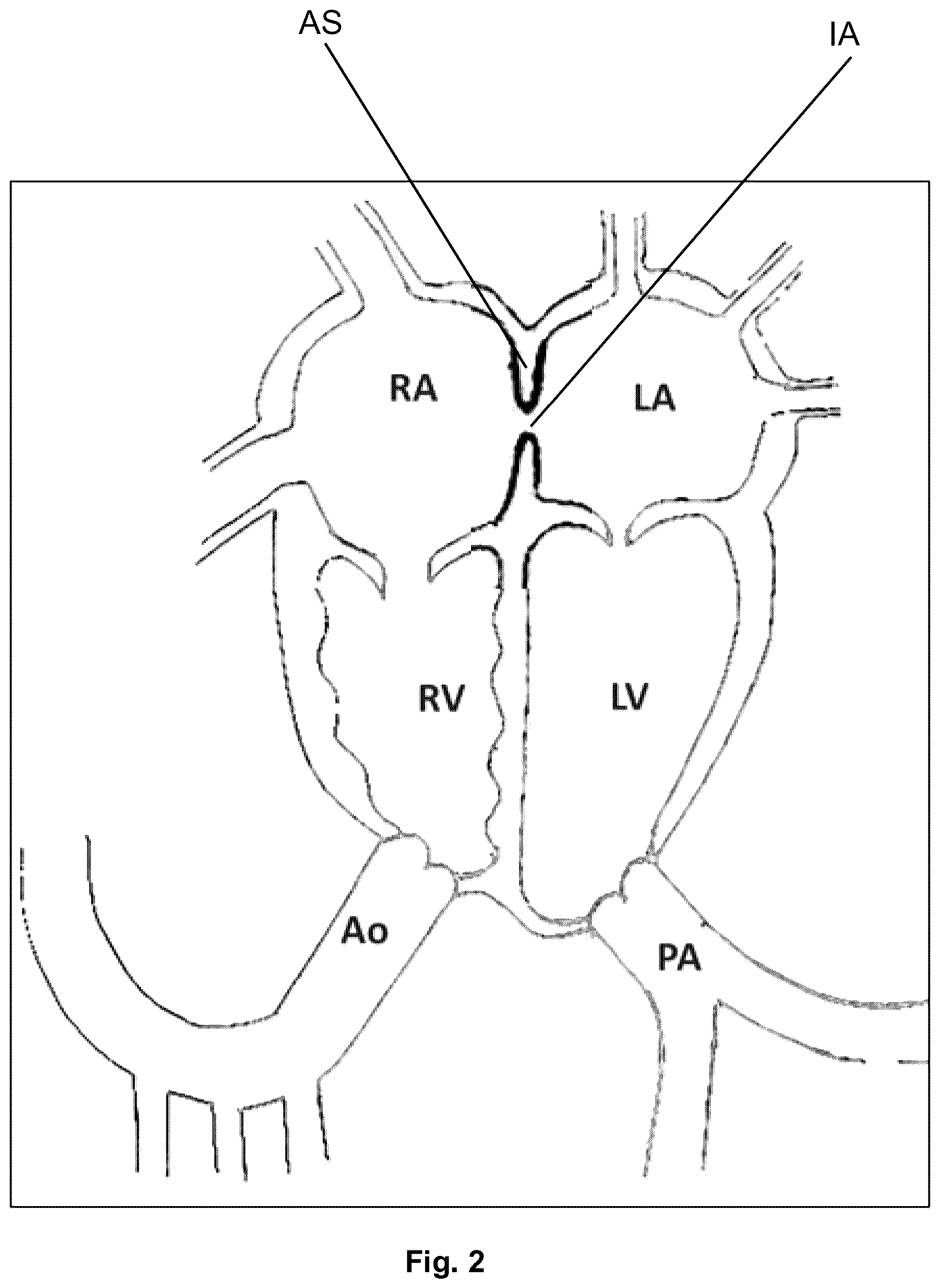 Patent US12310616 Figure 2 – Septostomy balloon catheter