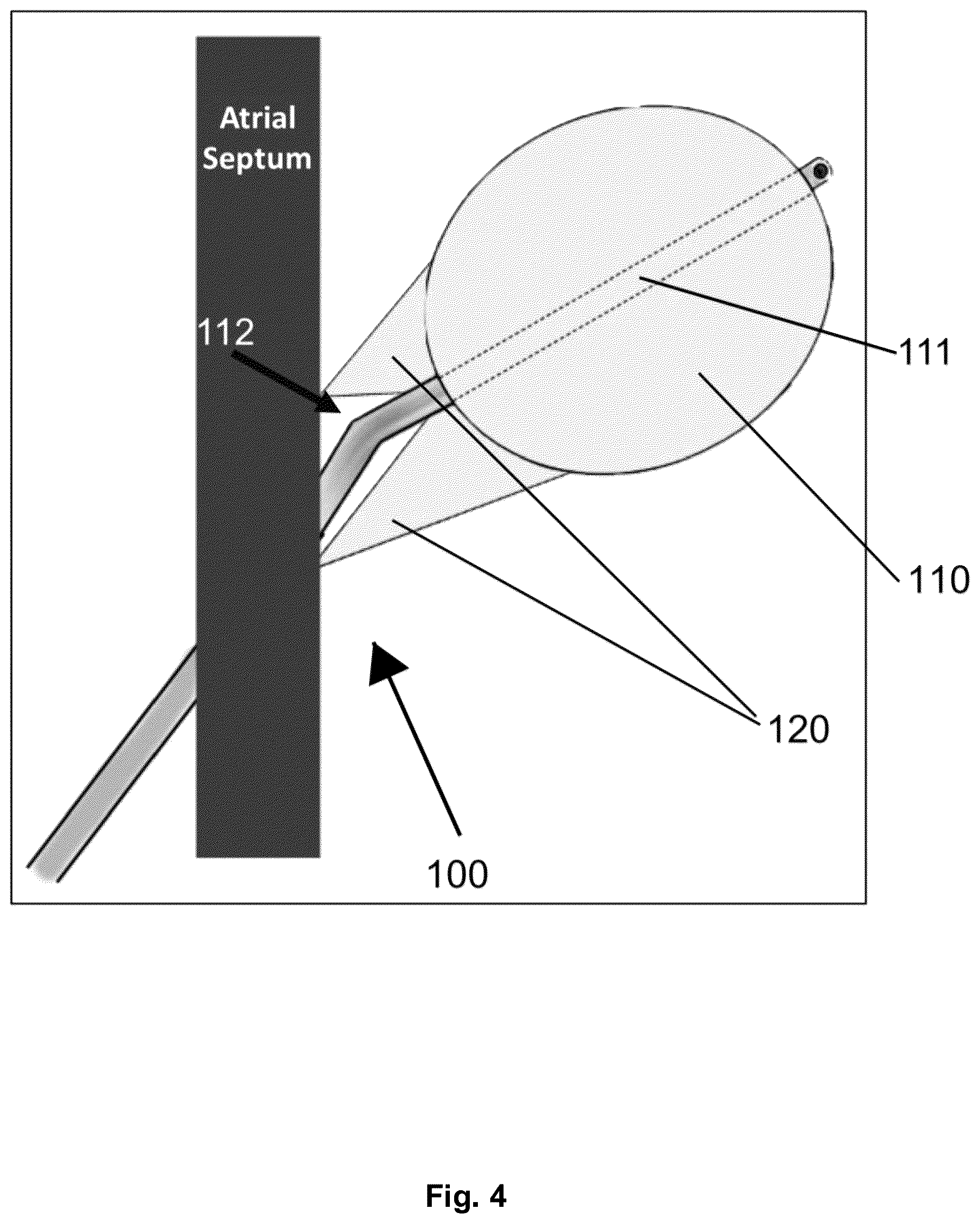 Patent US12310616 Figure 4 – Septostomy balloon catheter