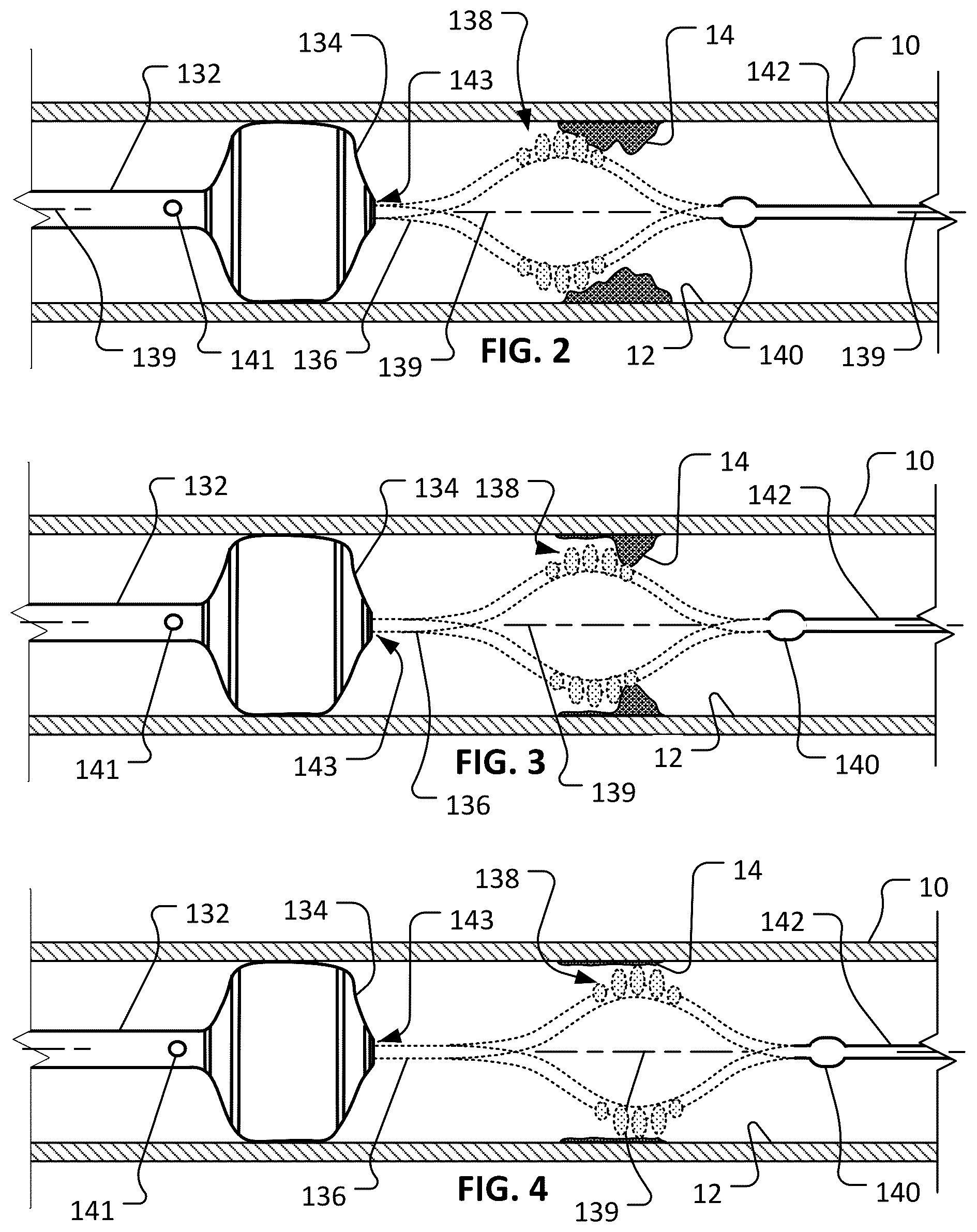 Patent US12310617 Figure 2 – Atherectomy devices and methods