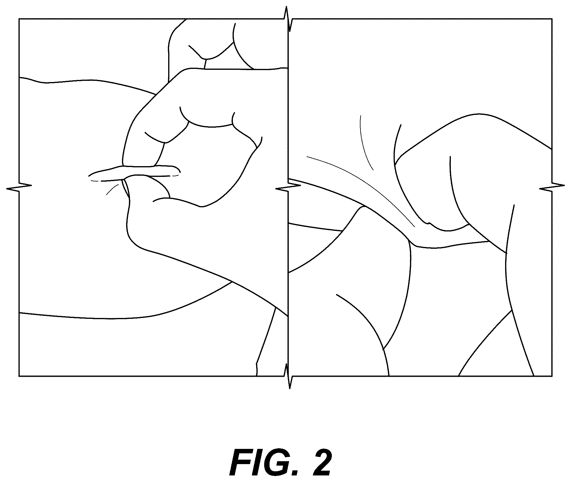 Patent US12310622 Figure 2 – Implant removal method