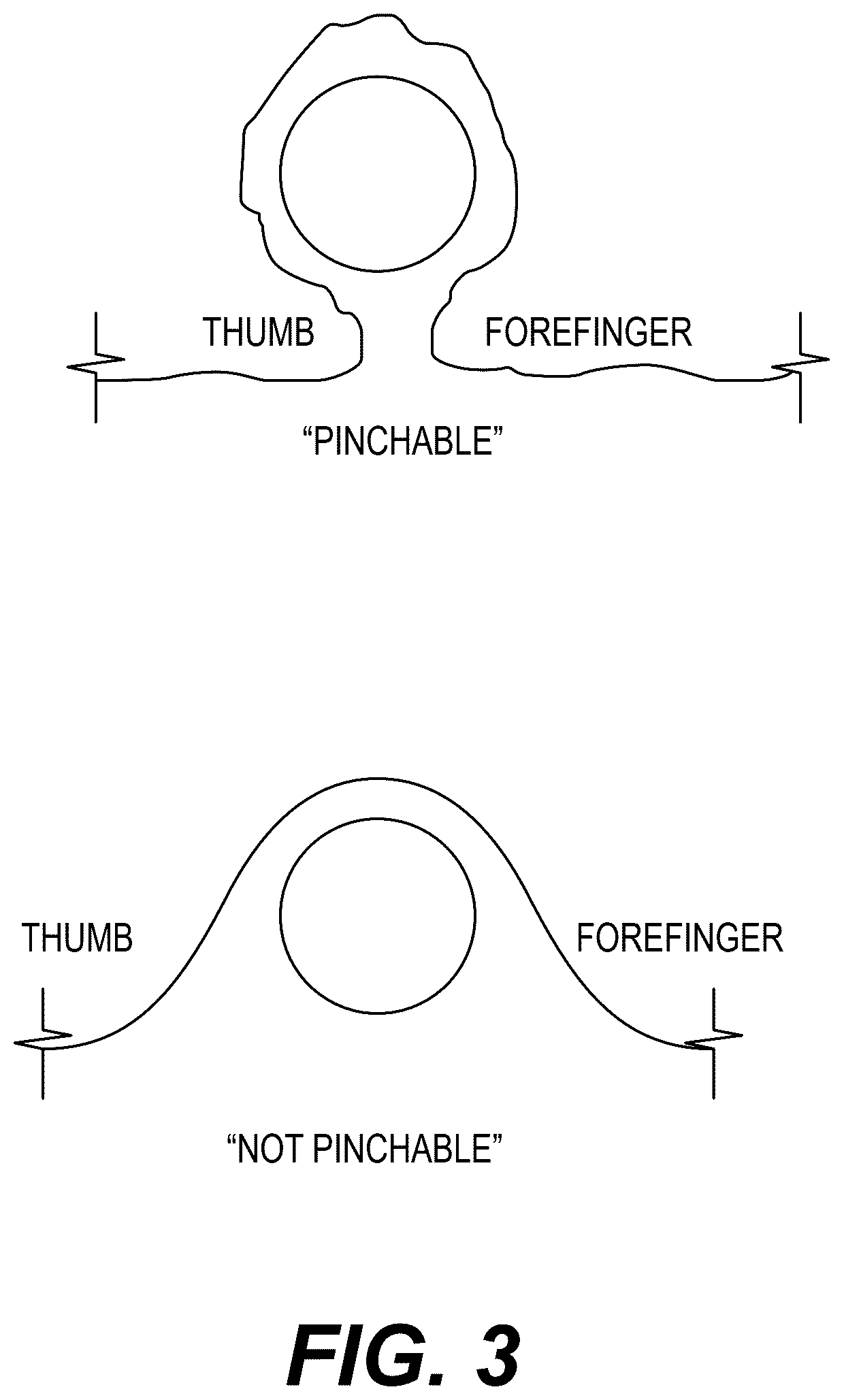 Patent US12310622 Figure 3 – Implant removal method