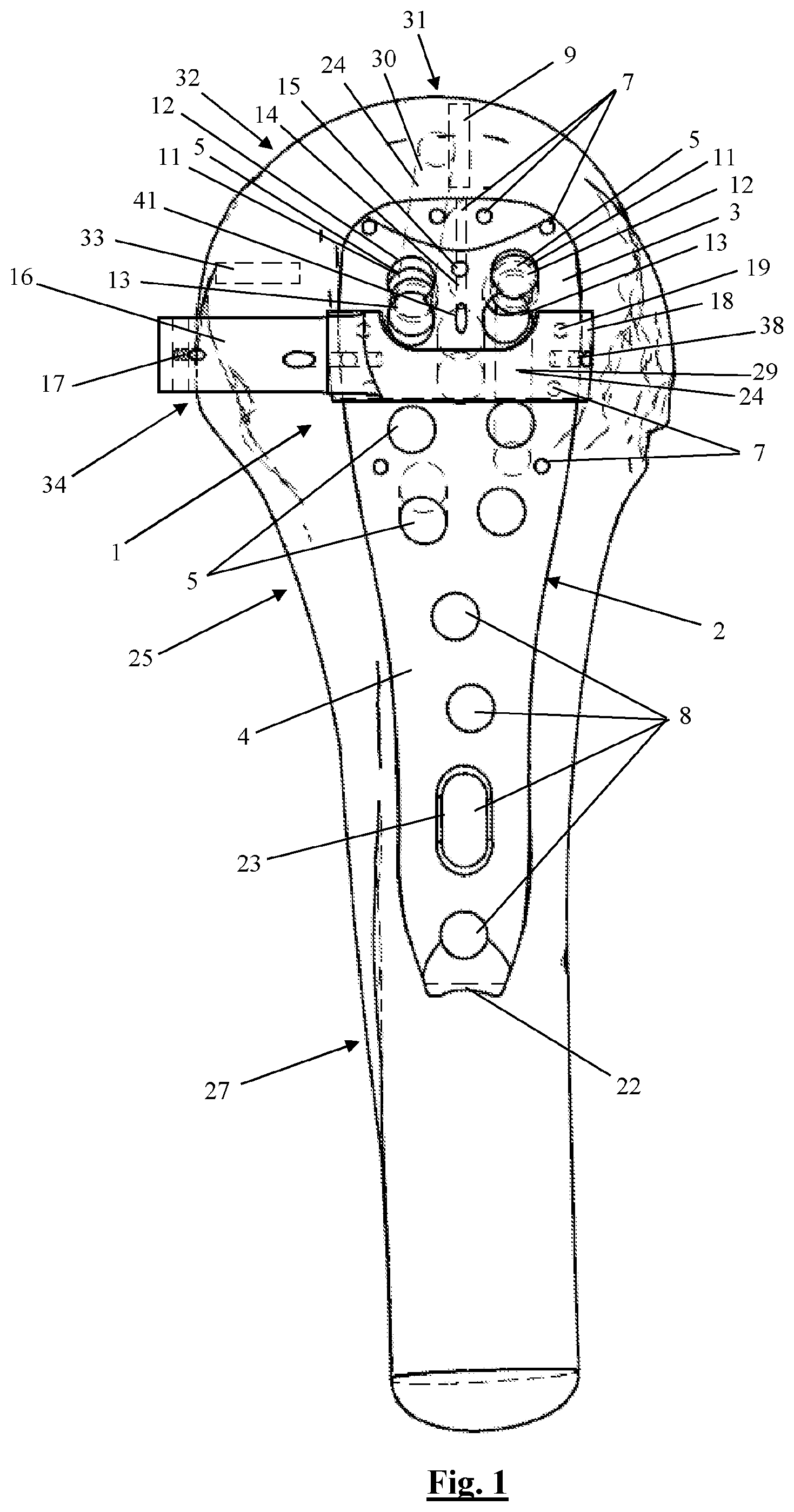 Patent US12310628 Figure 1 – Proximal humeral fixation plate and method for placing such a fixation plate