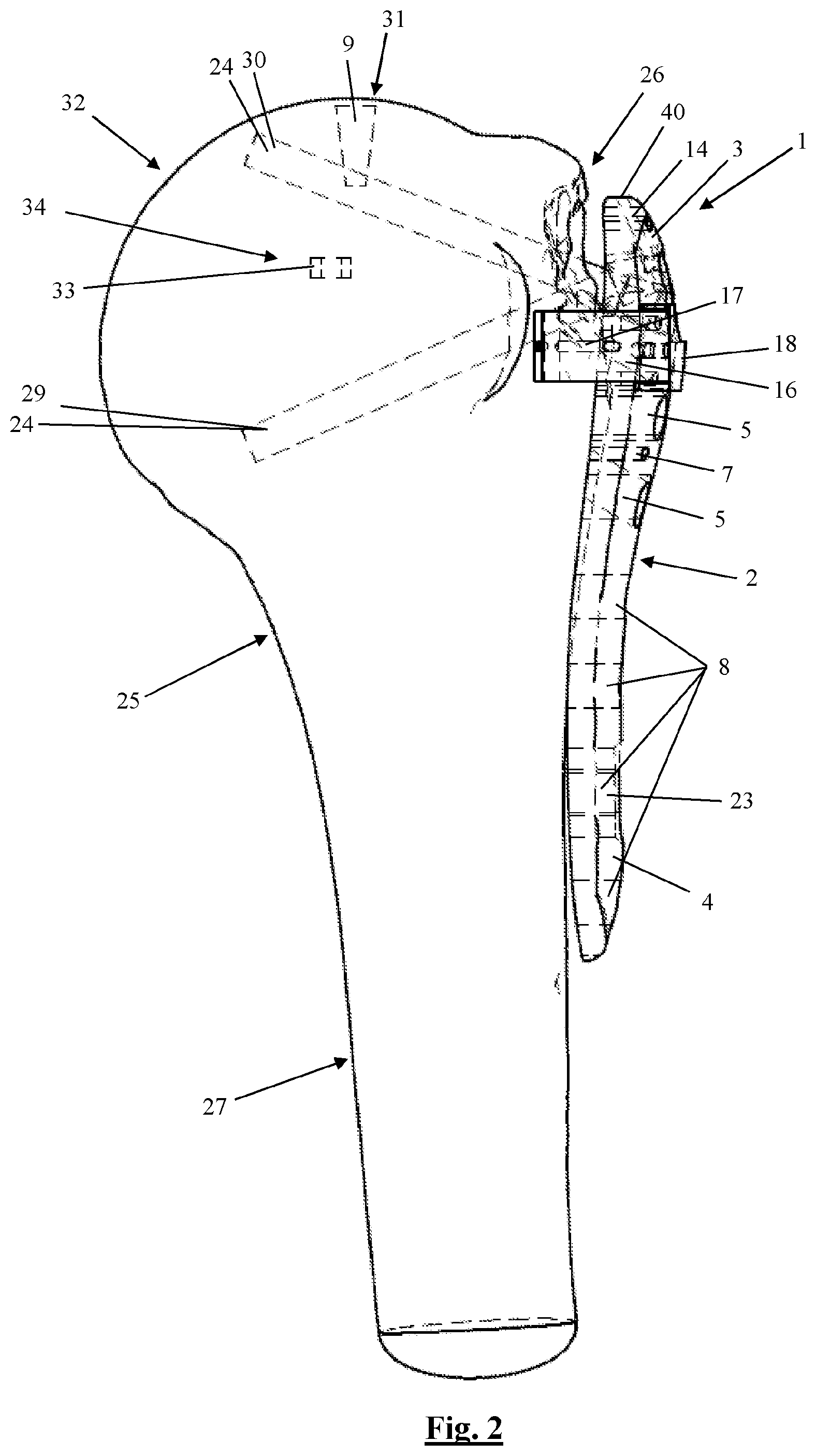 Patent US12310628 Figure 2 – Proximal humeral fixation plate and method for placing such a fixation plate