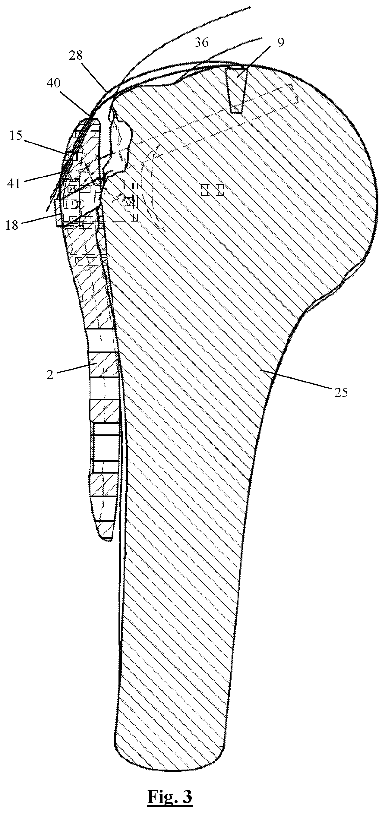 Patent US12310628 Figure 3 – Proximal humeral fixation plate and method for placing such a fixation plate
