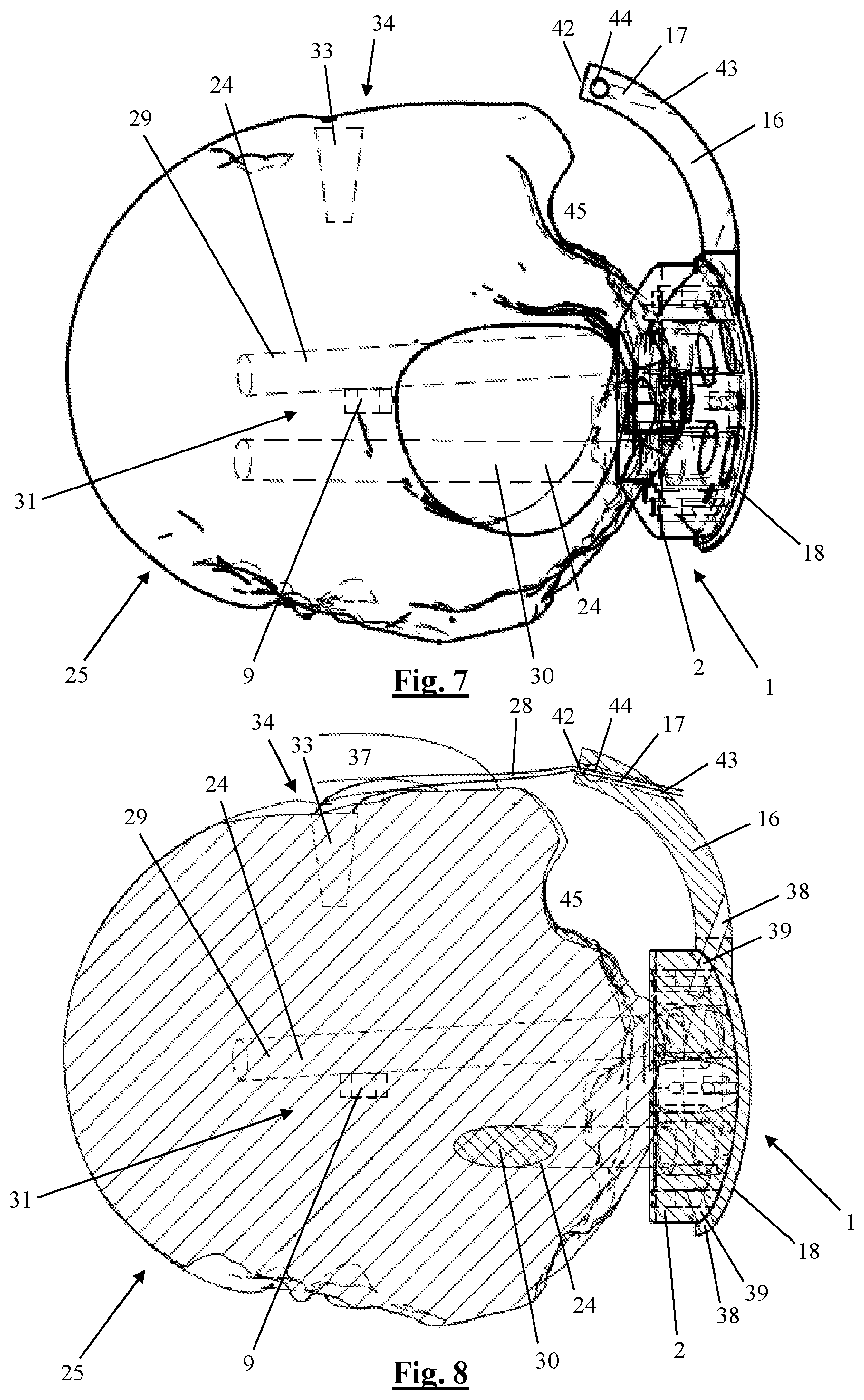 Patent US12310628 Figure 6 – Proximal humeral fixation plate and method for placing such a fixation plate