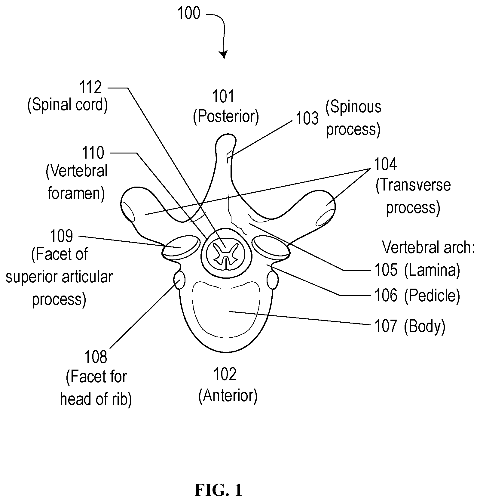 Patent US12310629 — Methods and devices for augmenting the spine — Figure 1