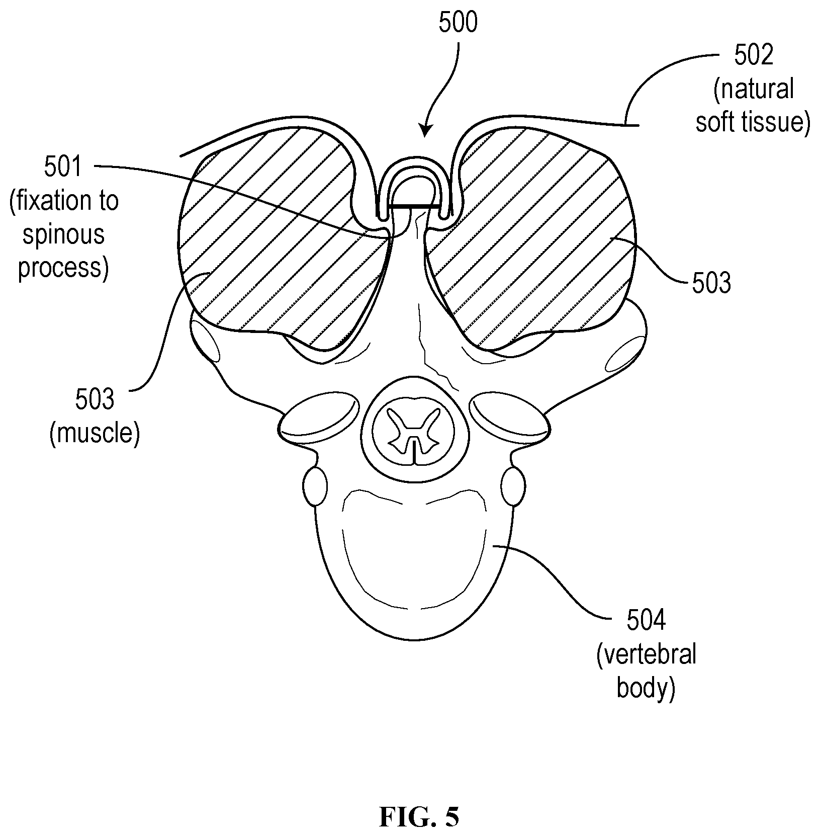 Patent US12310629 Figure 5 – Methods and devices for augmenting the spine