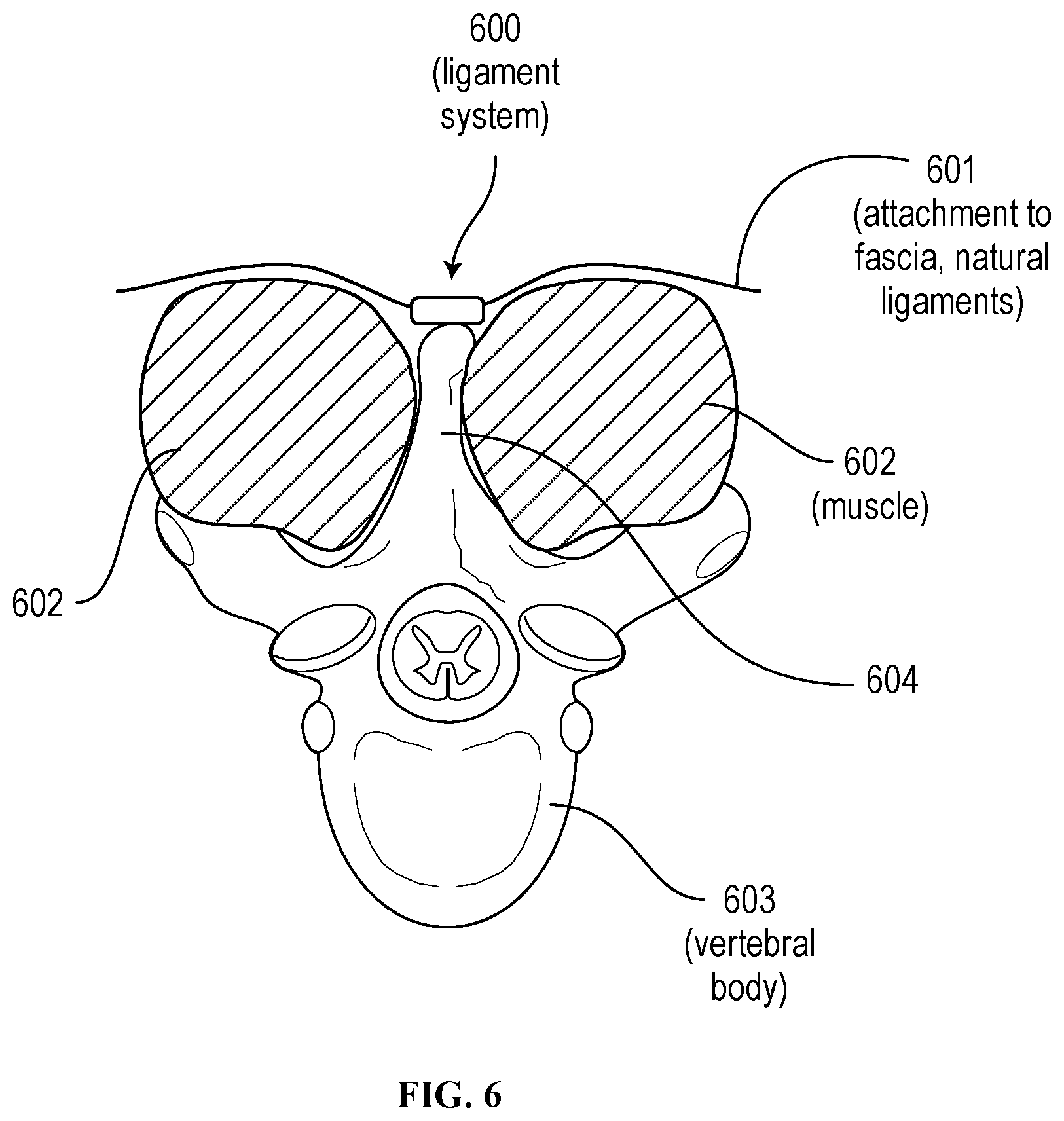 Patent US12310629 Figure 6 – Methods and devices for augmenting the spine