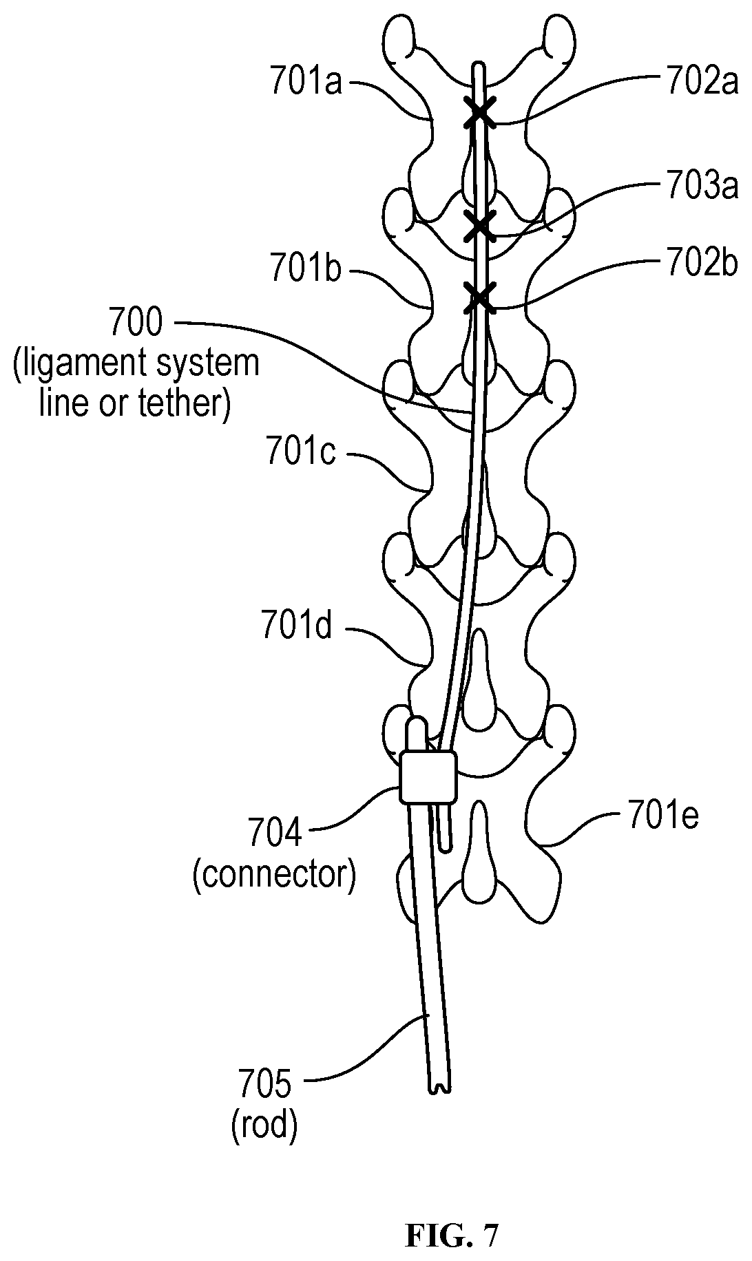 Patent US12310629 Figure 7 – Methods and devices for augmenting the spine